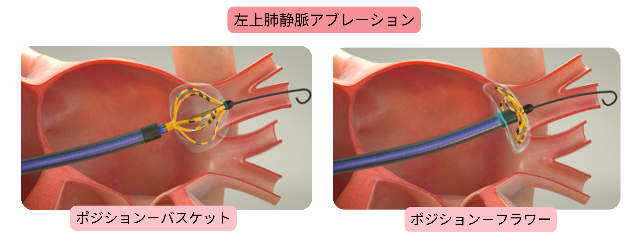心房細動のカテーテルアブレーションを示す模式図で、左上肺静脈の隔離と、バスケット型およびフラワー型ポジションでのアブレーションカテーテル位置を示す。