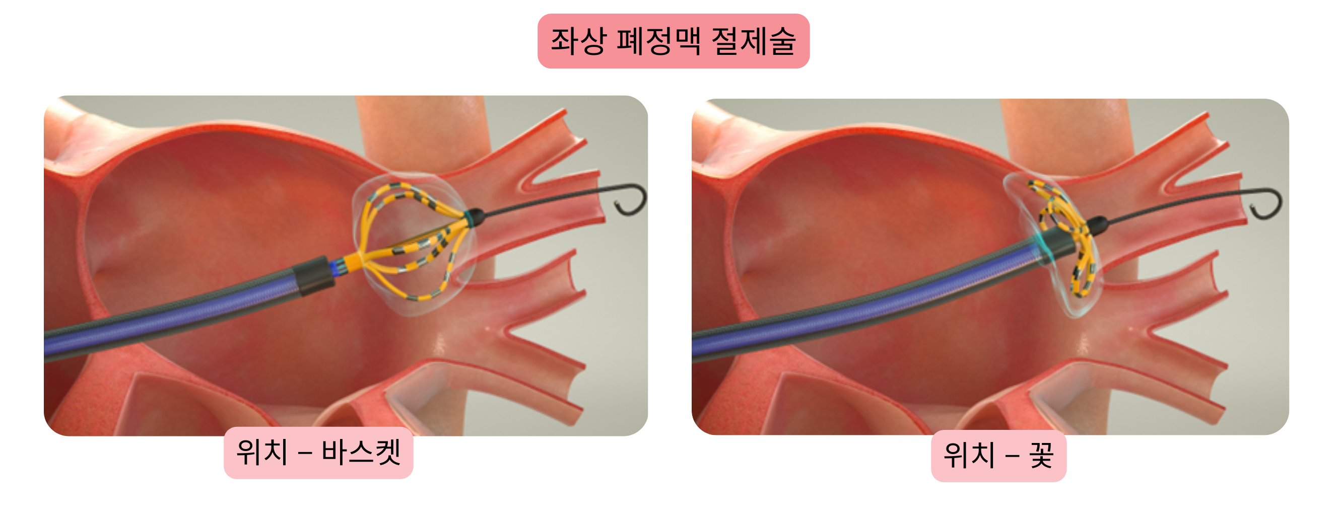 심방세동 카테터 절제술 도식으로, 좌상폐정맥 격리와 바스켓 및 플라워 포지션에서의 절제 카테터 위치를 보여준다.