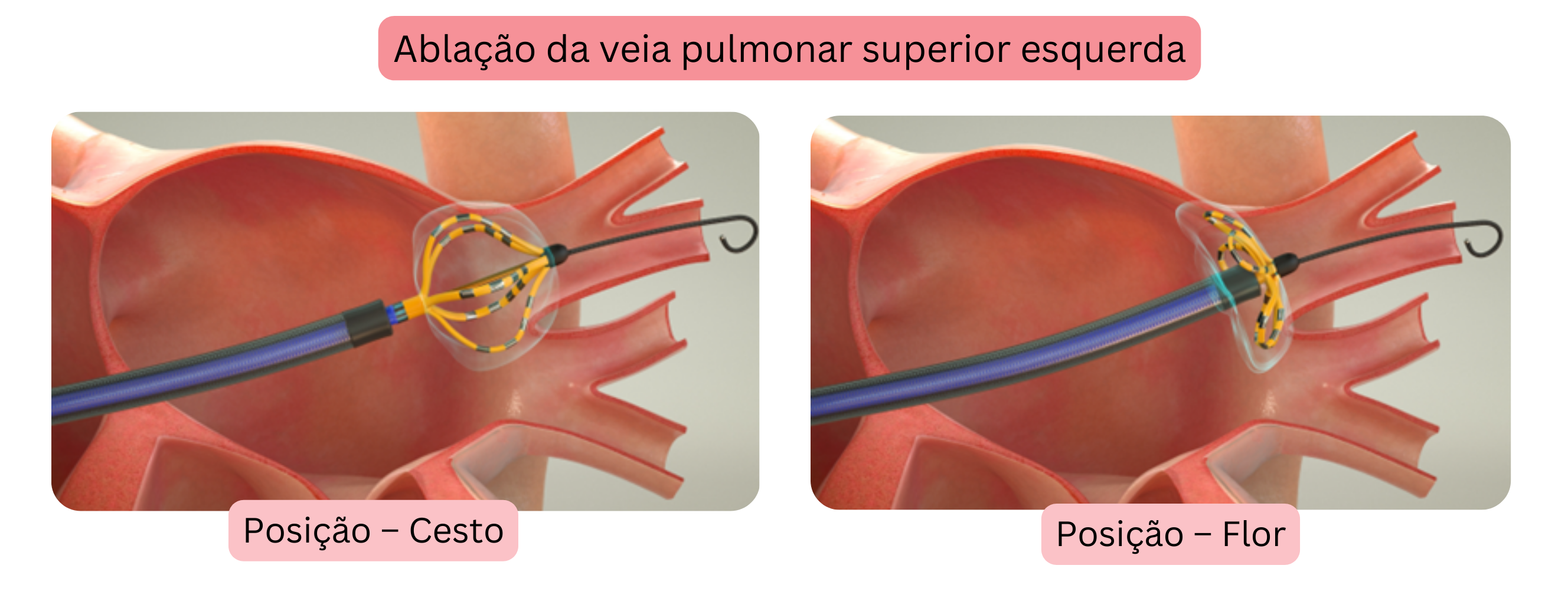 Esquema da ablação por cateter da fibrilação atrial demonstrando o isolamento da veia pulmonar superior esquerda com o cateter de ablação nas posições de cesta e flor.