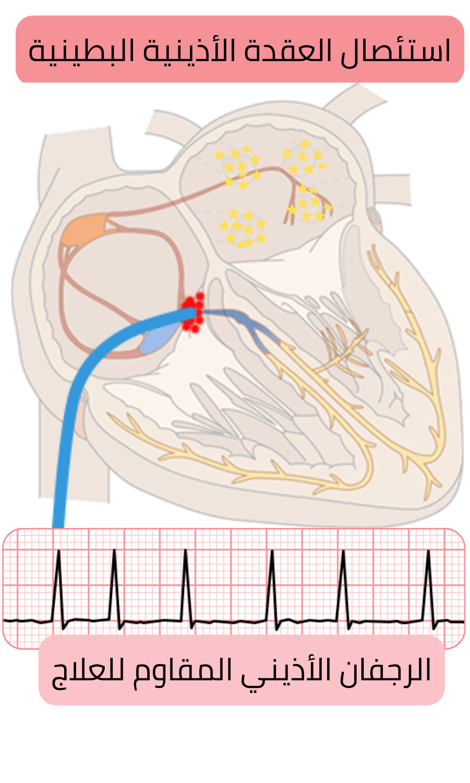 مخطط استئصال العقدة الأذينية البطينية في الرجفان الأذيني المقاوم للعلاج موضحًا إيقاف التوصيل الأذيني البطيني مع التحكم بمعدل البطين بواسطة التنبيه الدائم.