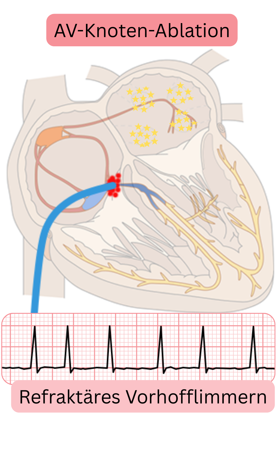 Schema der AV-Knoten-Ablation bei refraktärem Vorhofflimmern mit Darstellung der Unterbrechung der AV-Überleitung und anschließender Kontrolle der Kammerfrequenz durch permanente Stimulation.