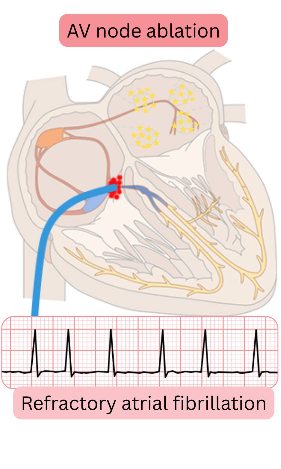 Diagram of atrioventricular node ablation in refractory atrial fibrillation illustrating interruption of AV conduction with subsequent ventricular rate control by permanent pacing.