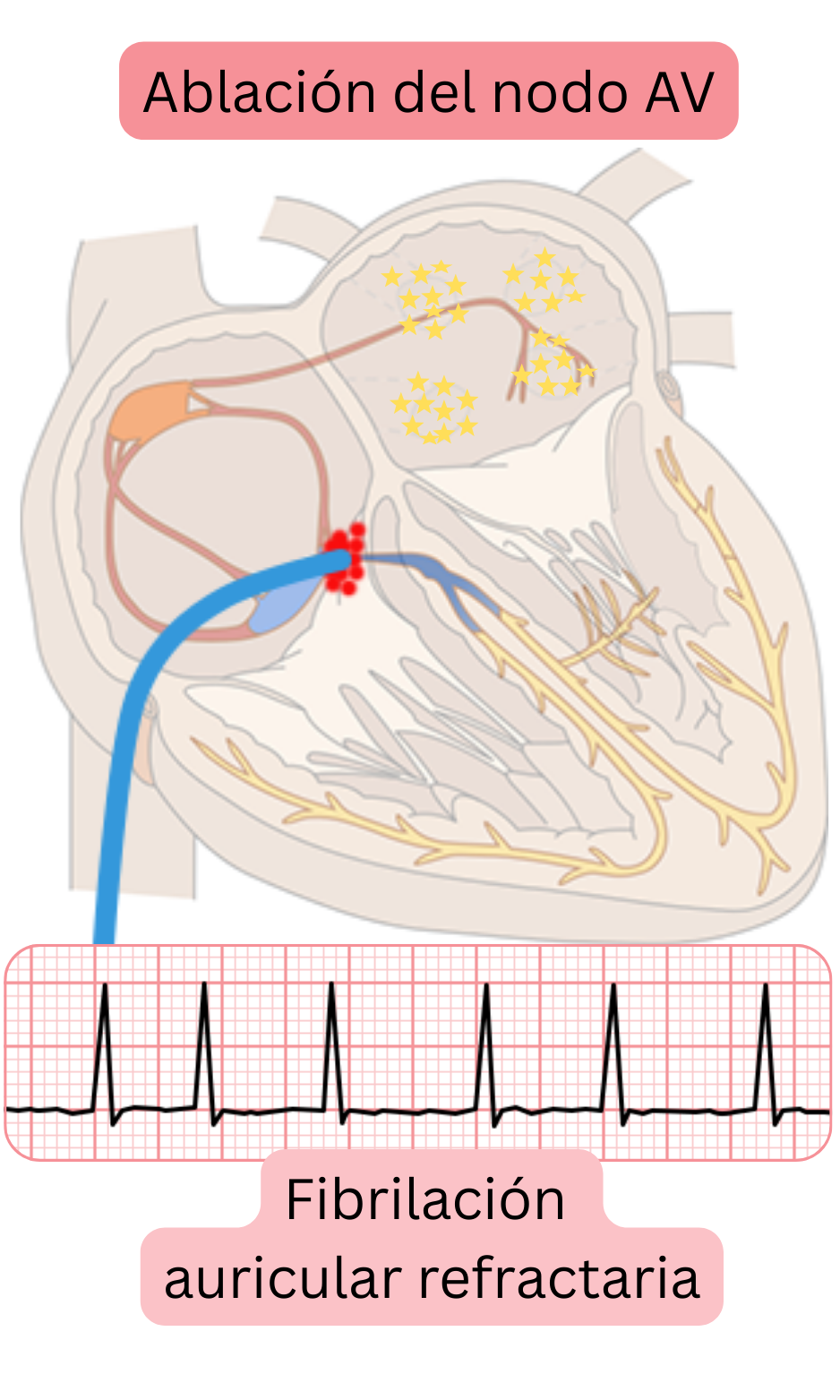 Esquema de ablación del nodo auriculoventricular en fibrilación auricular refractaria que muestra la interrupción de la conducción AV y el control de la frecuencia ventricular mediante estimulación permanente.