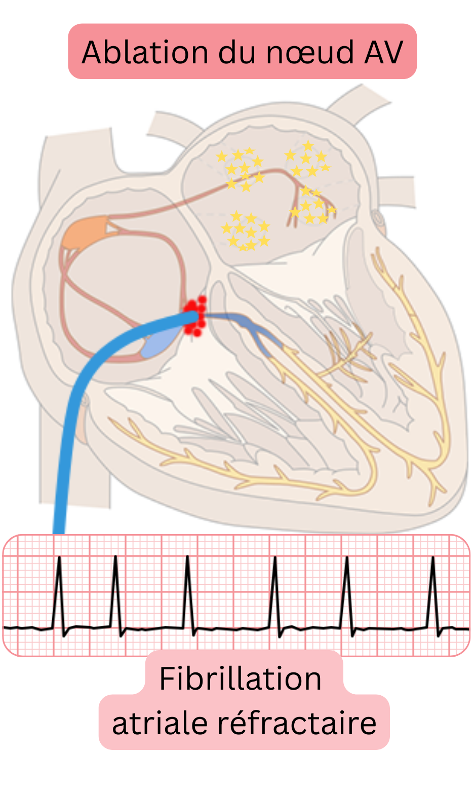 Schéma d’ablation du nœud atrioventriculaire dans la fibrillation atriale réfractaire illustrant l’interruption de la conduction AV et le contrôle de la fréquence ventriculaire par stimulation permanente.