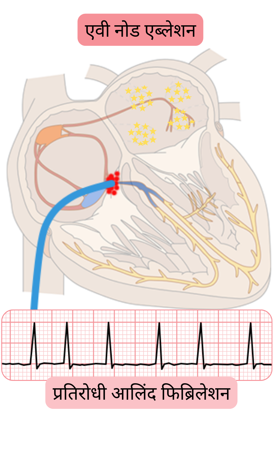 रिफ्रैक्टरी एट्रियल फ़िब्रिलेशन में एवी नोड एब्लेशन का आरेख, जिसमें एवी कंडक्शन का अवरोध और स्थायी पेसिंग द्वारा वेंट्रिकुलर रेट नियंत्रण दर्शाया गया है।