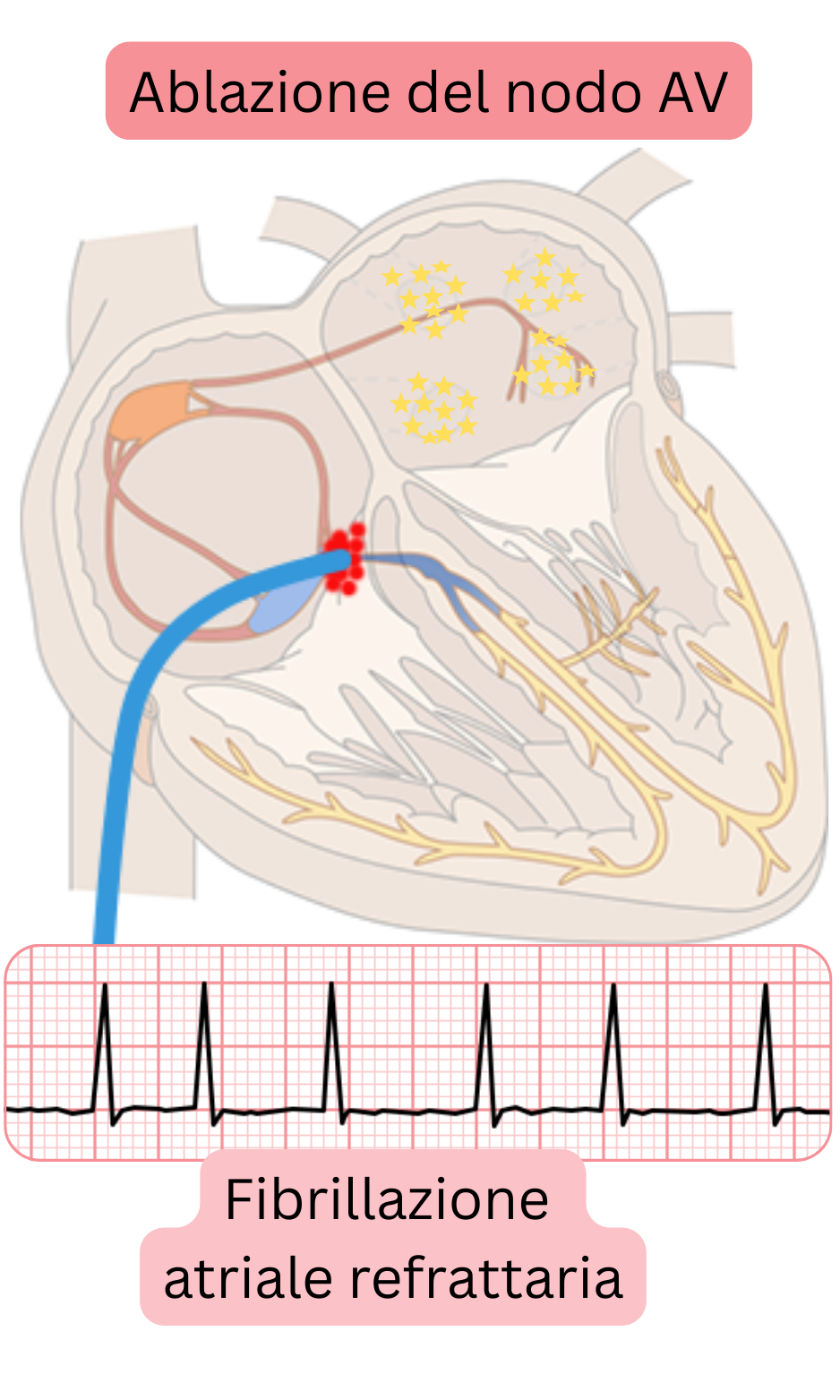 Schema di ablazione del nodo atrioventricolare nella fibrillazione atriale refrattaria che illustra l’interruzione della conduzione AV e il controllo della frequenza ventricolare mediante stimolazione permanente.