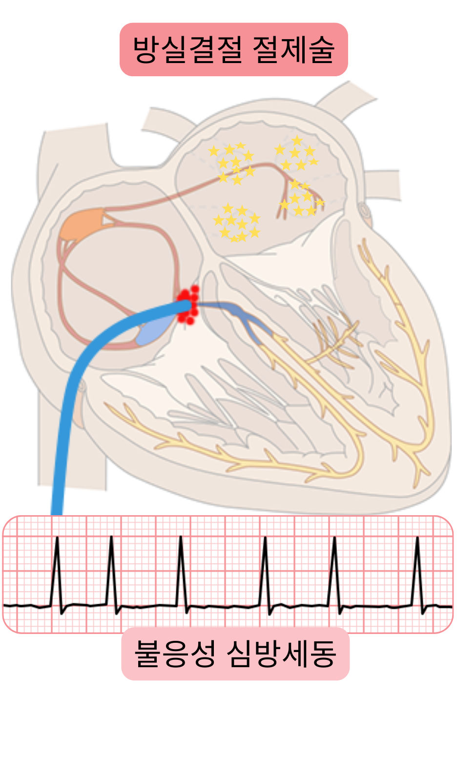 난치성 심방세동에서 방실결절 절제술을 나타낸 도식으로, 방실 전도 차단과 영구 심박동기 삽입을 통한 심실박동수 조절을 보여준다.