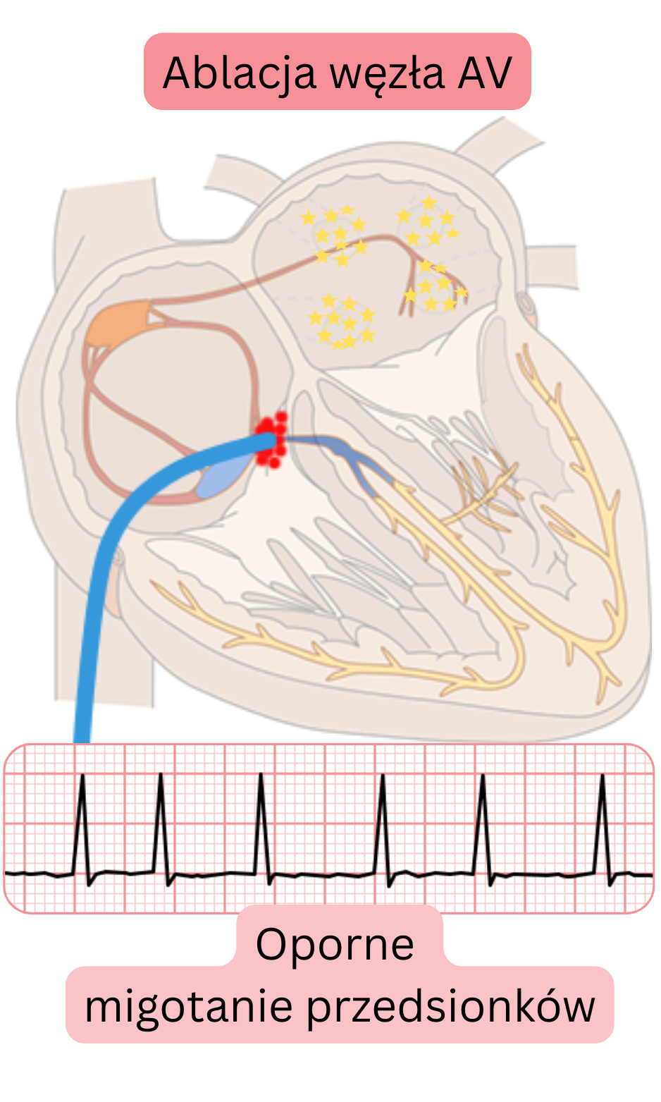 Schemat ablacji węzła przedsionkowo-komorowego w opornej migotaniu przedsionków, przedstawiający przerwanie przewodzenia AV oraz kontrolę częstości komór za pomocą stałej stymulacji.