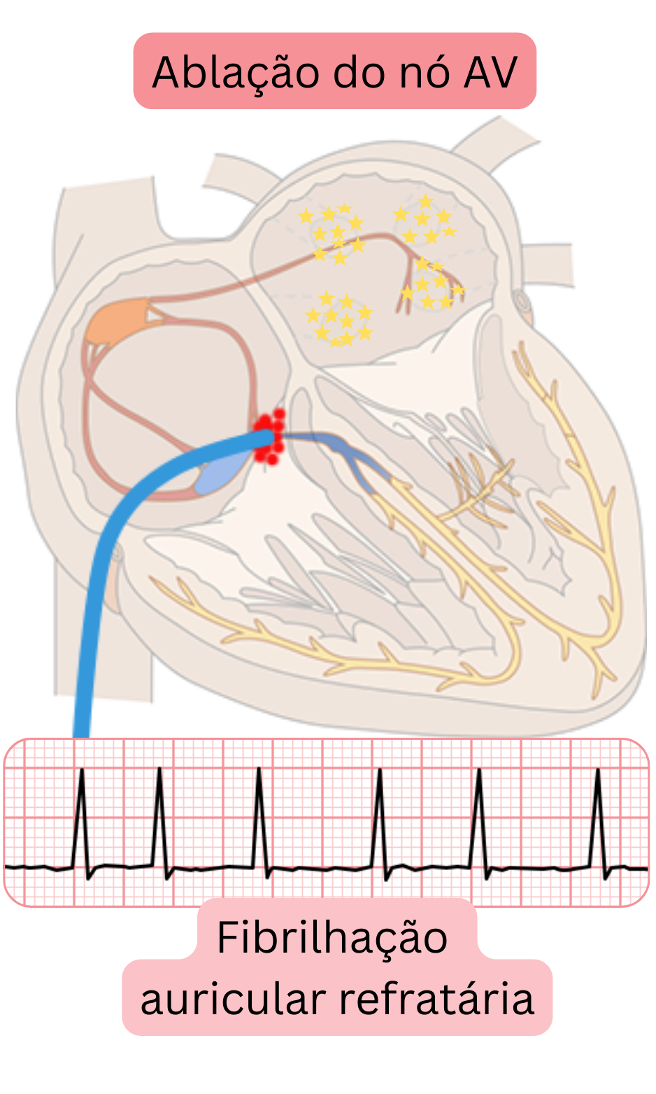 Esquema de ablação do nó atrioventricular na fibrilação atrial refratária demonstrando a interrupção da condução AV e o controle da frequência ventricular por estimulação permanente.