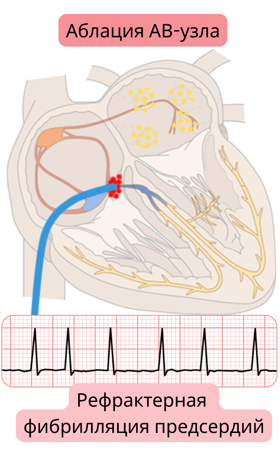 Схема аблации атриовентрикулярного узла при рефрактерной фибрилляции предсердий с демонстрацией блокады AV-проведения и контроля частоты желудочков с помощью постоянной стимуляции.