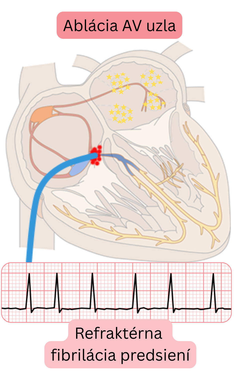 Schéma ablácie AV uzla pri refraktérnej fibrilácii predsiení znázorňujúca prerušenie atrioventrikulárneho vedenia s následnou kontrolou komorovej frekvencie pomocou trvalej stimulácie.