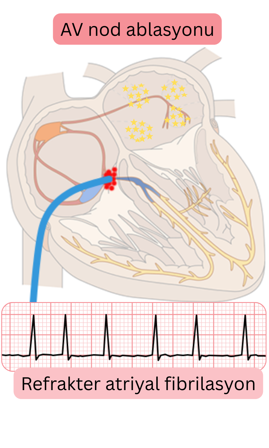 Refrakter atriyal fibrilasyonda AV nod ablasyonunu gösteren şema; AV iletimin kesilmesini ve kalıcı pacing ile ventrikül hız kontrolünü göstermektedir.
