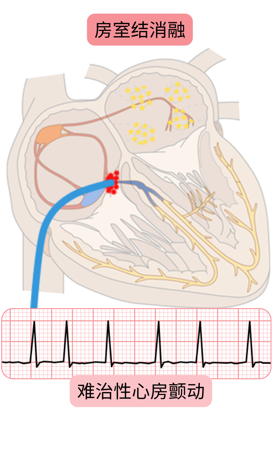难治性心房颤动患者房室结消融示意图，显示房室传导阻断并通过永久起搏实现心室率控制。