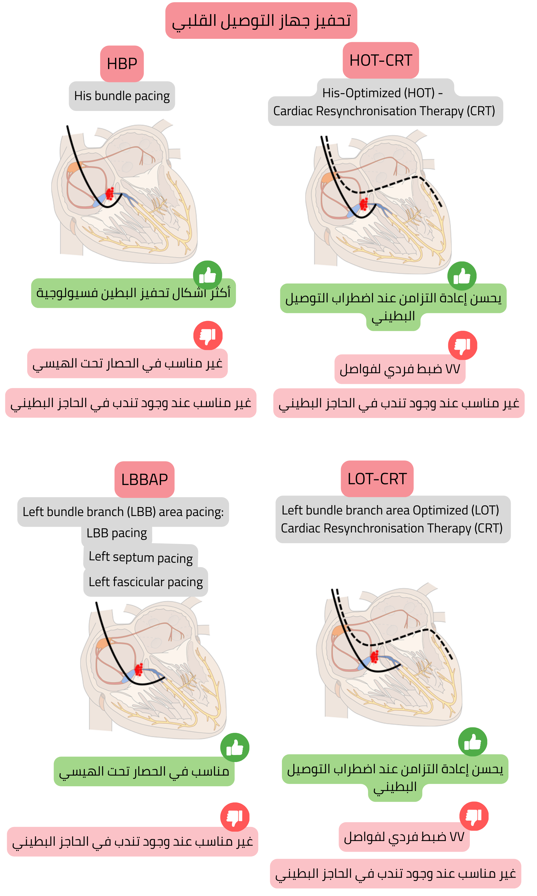 مخطط تحفيز نظام التوصيل يقارن بين تحفيز حزمة هيس، تحفيز منطقة فرع الحزمة اليسرى، وتركيباتهما مع CRT، مع التركيز على التنشيط البطيني الفيزيولوجي وإعادة التزامن الفعالة.