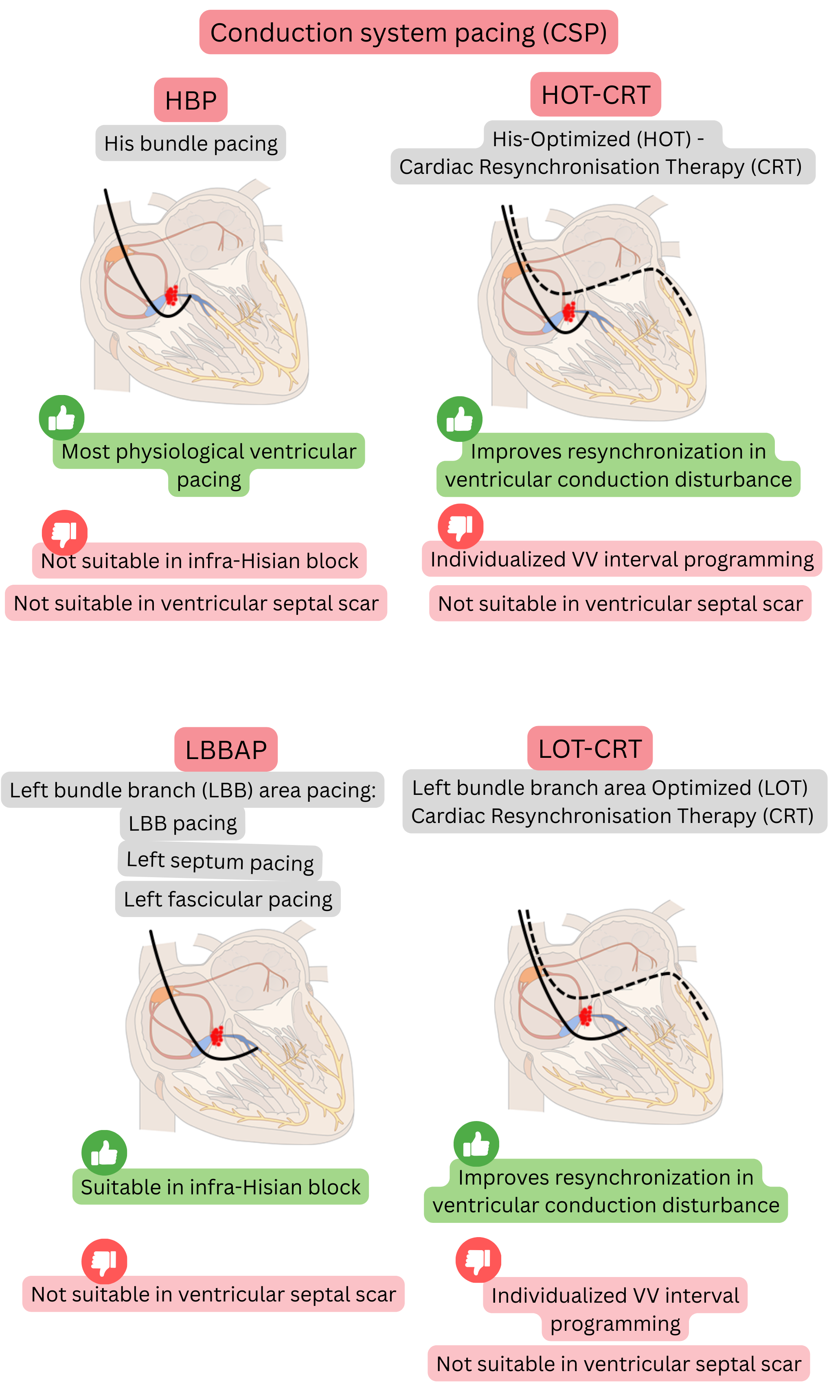 Diagram of conduction system pacing comparing His bundle pacing, left bundle branch area pacing, and their combinations with CRT, focusing on physiological ventricular activation and effective resynchronization.