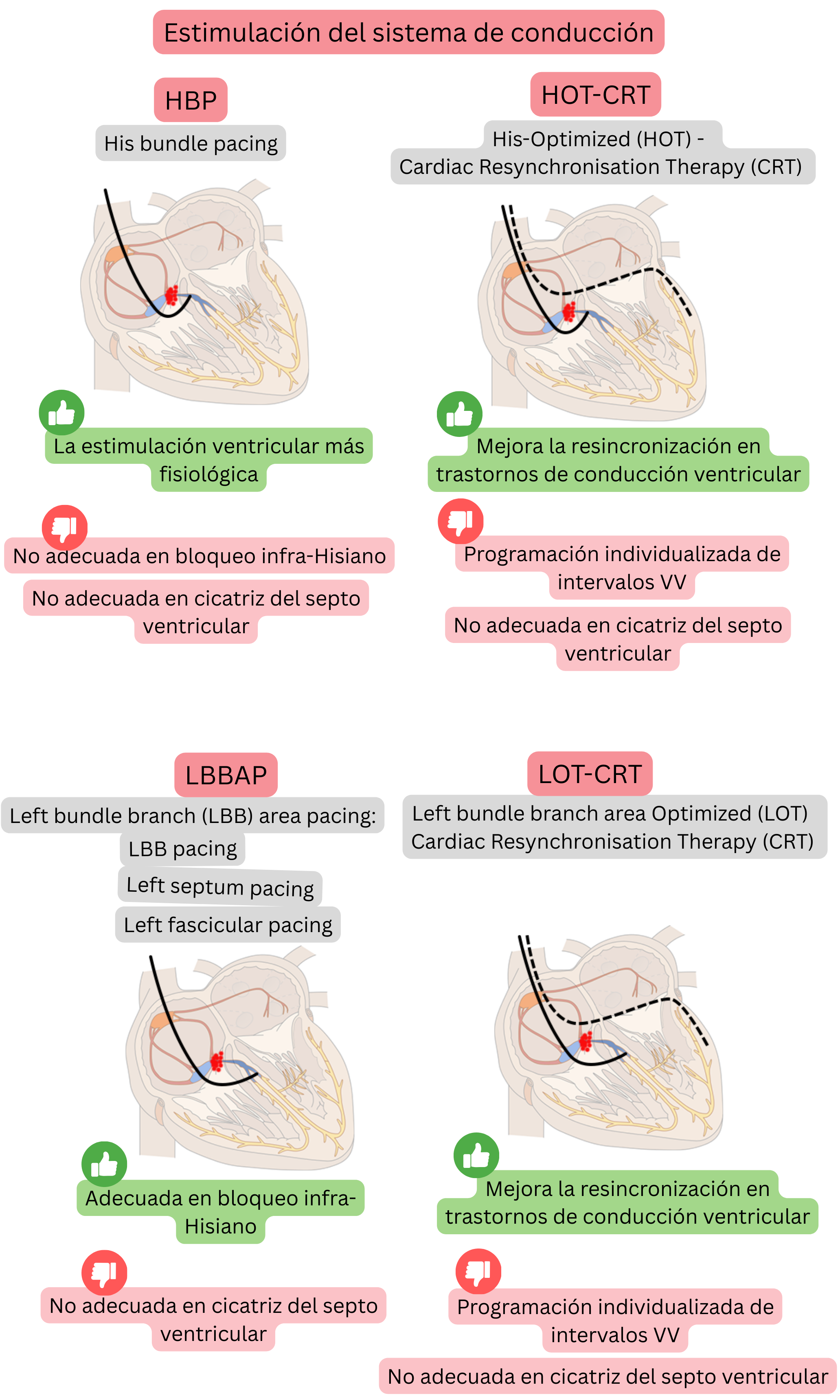 Esquema de estimulación del sistema de conducción que compara el his bundle pacing, el left bundle branch area pacing y sus combinaciones con CRT, con énfasis en la activación ventricular fisiológica y la resincronización eficaz.
