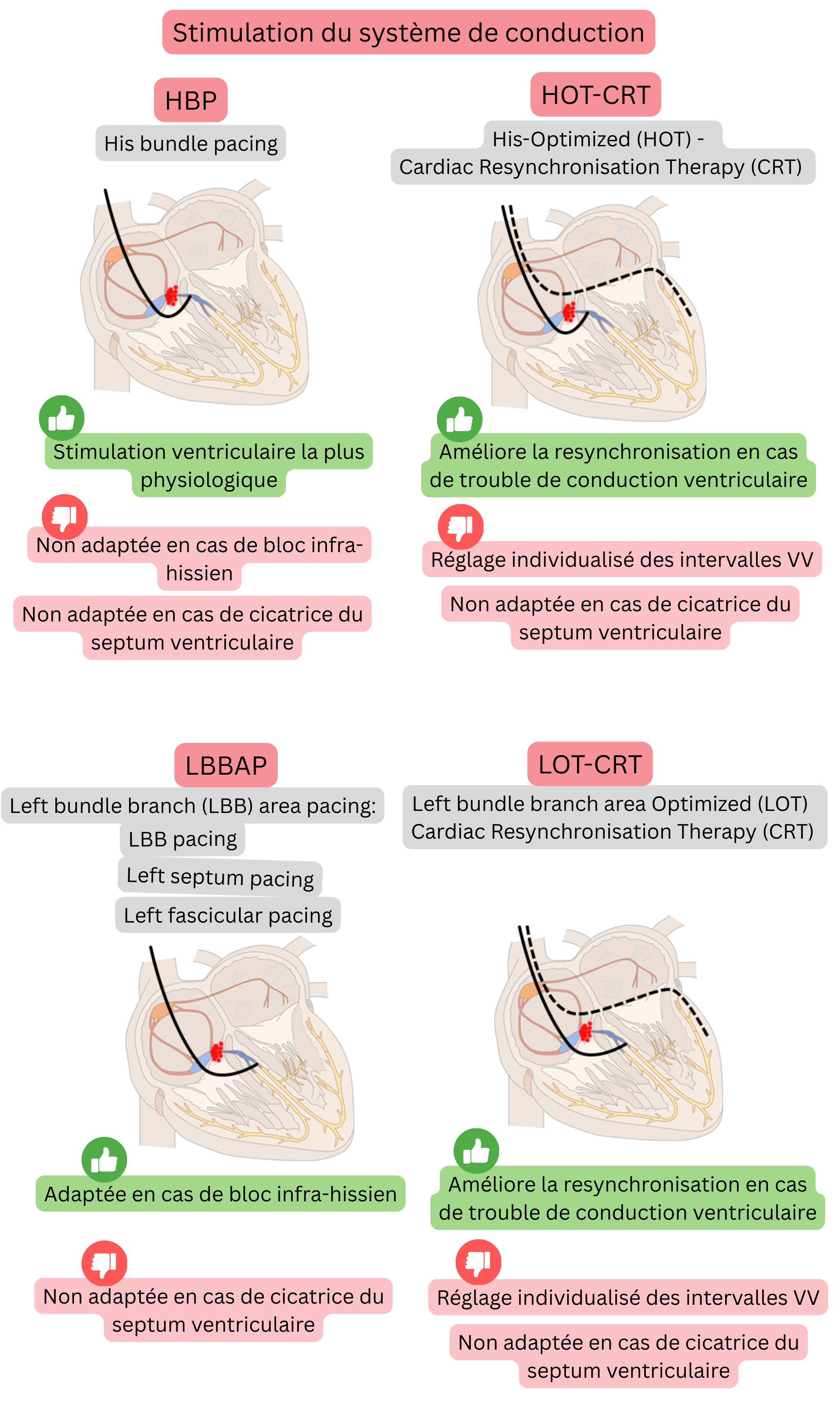 Schéma de stimulation du système de conduction comparant le his bundle pacing, le left bundle branch area pacing et leurs associations avec la CRT, en mettant l’accent sur l’activation ventriculaire physiologique et la resynchronisation efficace.