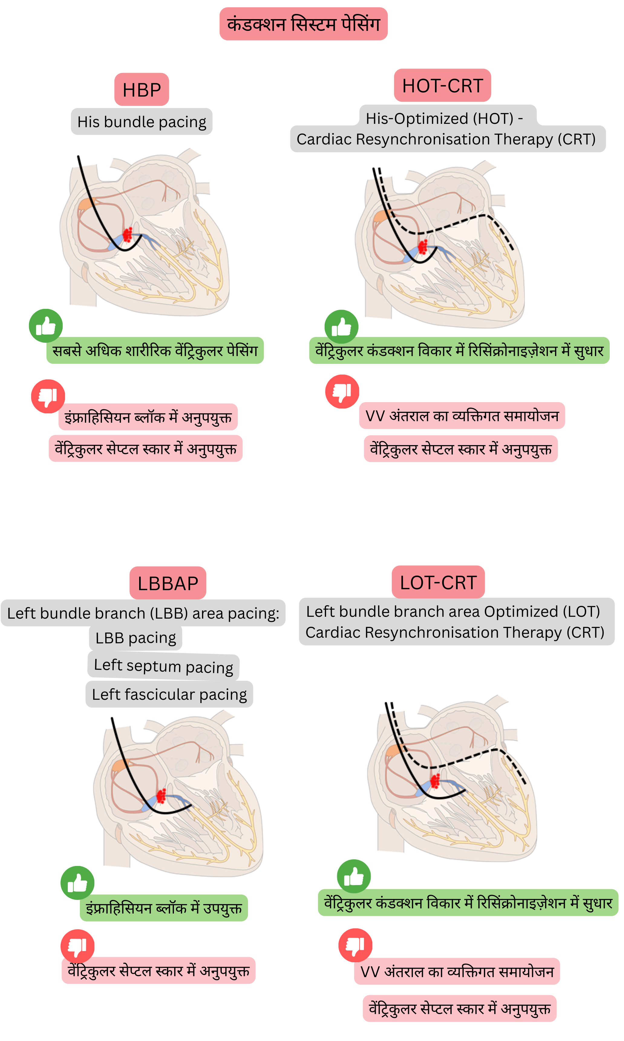 कंडक्शन सिस्टम पेसिंग का आरेख, जिसमें हिस बंडल पेसिंग, लेफ्ट बंडल ब्रांच एरिया पेसिंग और CRT के साथ उनके संयोजनों की तुलना की गई है, तथा शारीरिक वेंट्रिकुलर सक्रियण और प्रभावी रिसिंक्रोनाइज़ेशन पर ध्यान दिया गया है।