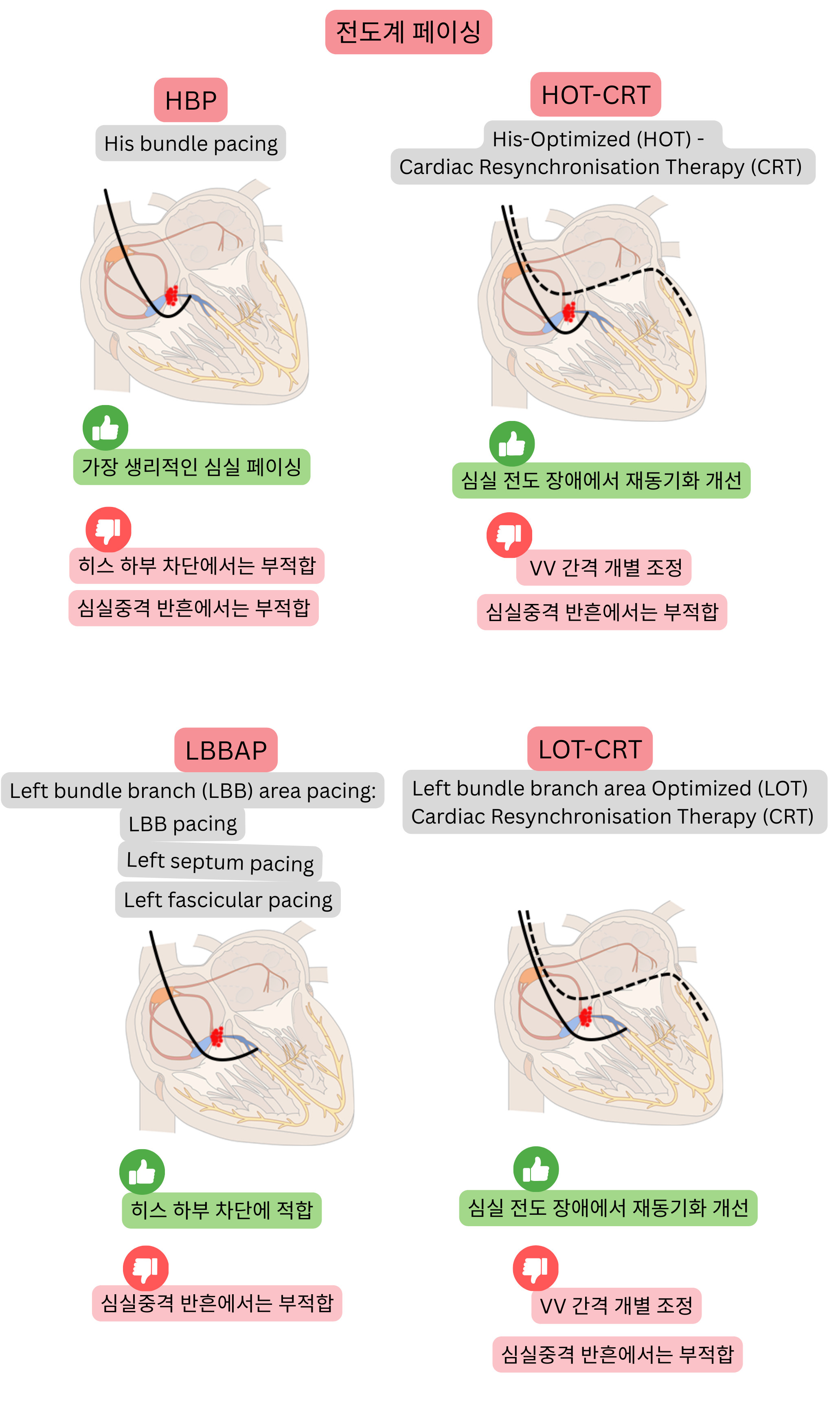 전도계 심박동 조율 도식으로, 히스 다발 조율, 좌각 분지 영역 조율 및 CRT와의 조합을 비교하여 생리적 심실 활성화와 효과적인 재동기화를 강조한다.