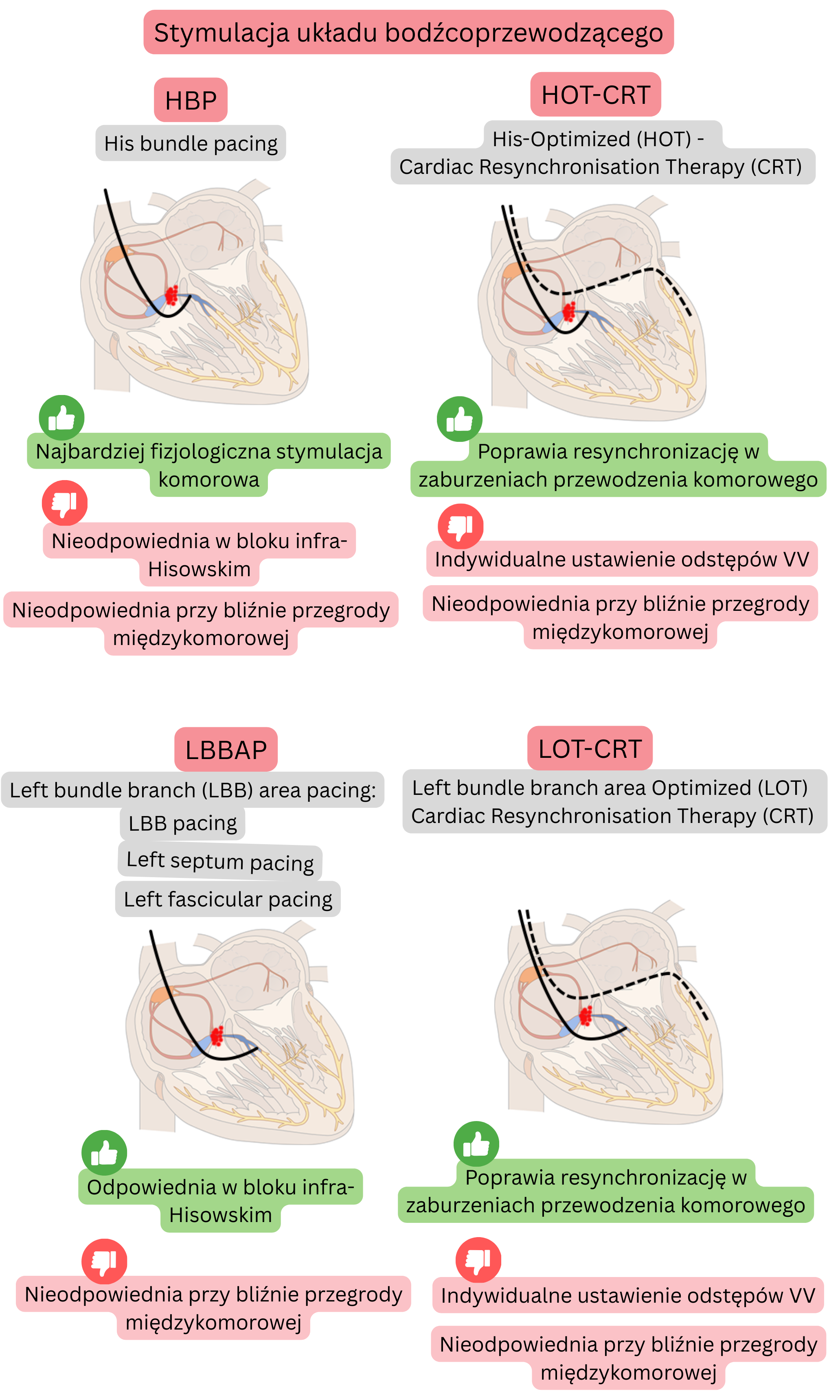 Schemat stymulacji układu bodźcoprzewodzącego porównujący his bundle pacing, left bundle branch area pacing oraz ich połączenia z CRT, z naciskiem na fizjologiczną aktywację komór i skuteczną resynchronizację.