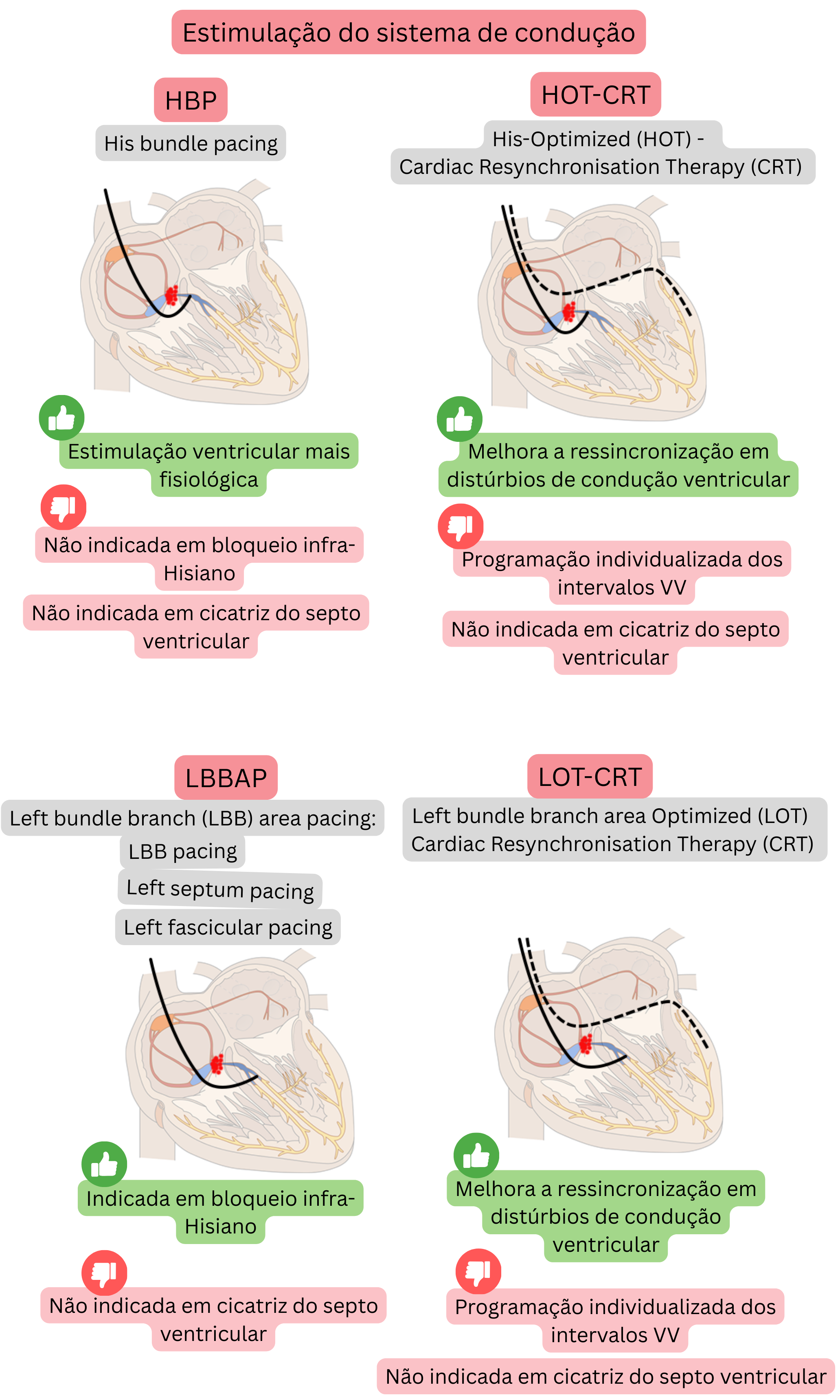 Esquema de estimulação do sistema de condução comparando his bundle pacing, left bundle branch area pacing e suas combinações com CRT, com foco na ativação ventricular fisiológica e na ressincronização eficaz.