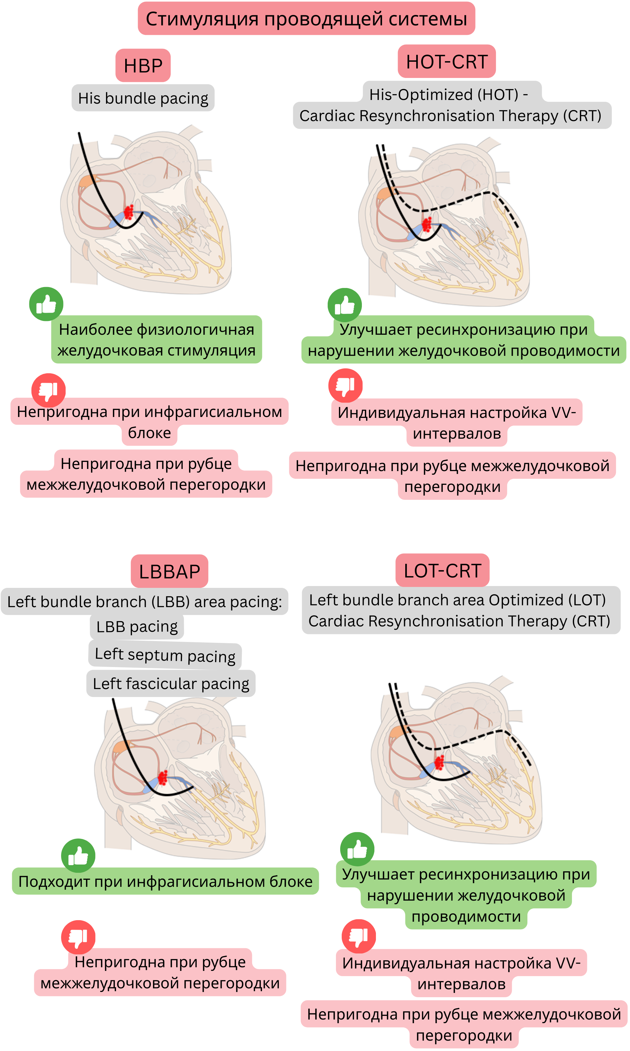 Схема стимуляции проводящей системы с сравнением стимуляции пучка Гиса, стимуляции области левой ножки пучка и их комбинаций с CRT, с акцентом на физиологическую активацию желудочков и эффективную ресинхронизацию.