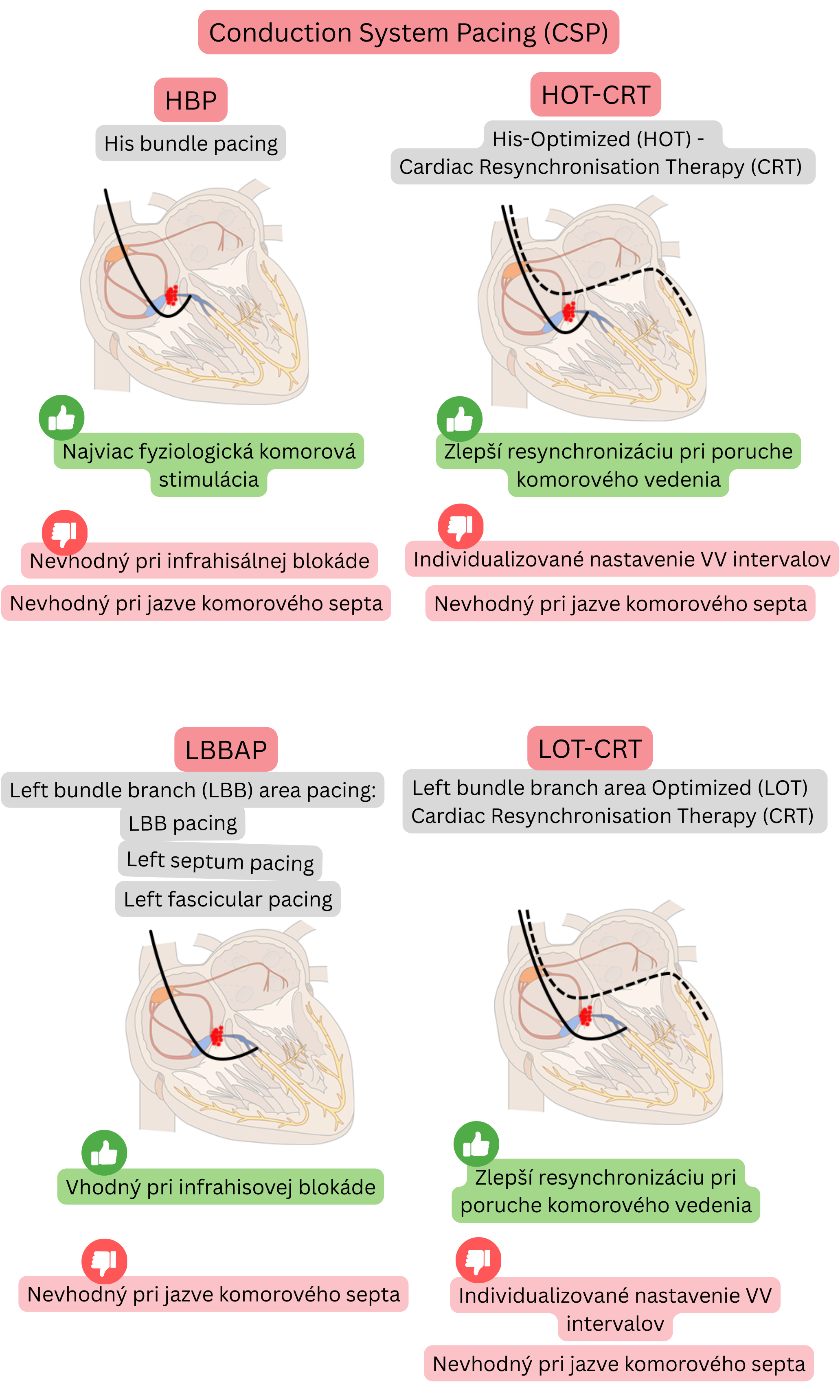 Schéma stimulácie prevodného systému porovnávajúca His bundle pacing, left bundle branch area pacing a ich kombinácie s CRT so zameraním na fyziologickú komorovú aktiváciu a účinnú resynchronizáciu.