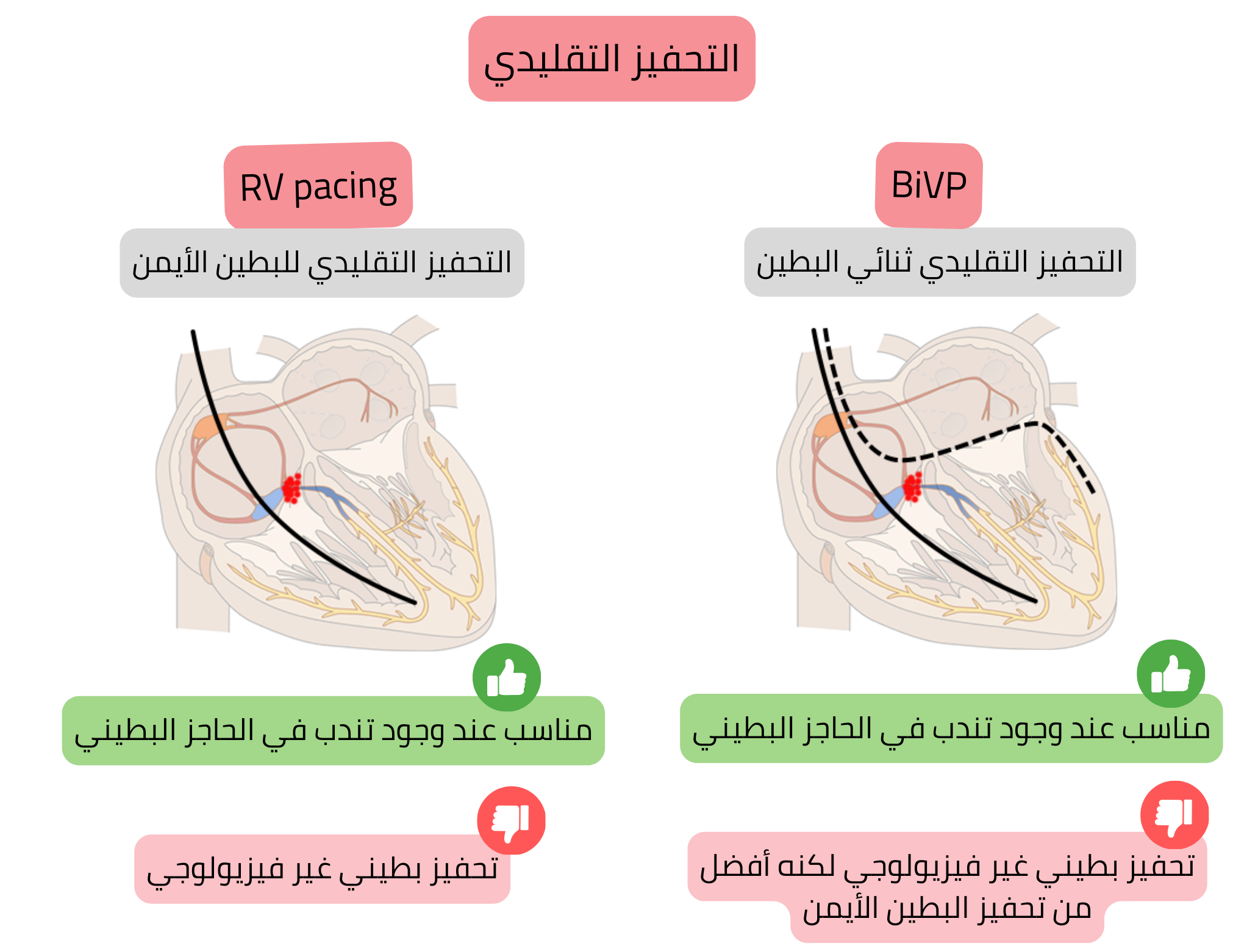 مخطط التحفيز التقليدي يقارن بين التحفيز البطيني الأيمن والتحفيز ثنائي البطين من حيث تأثيرهما على تزامن تنشيط البطين وفسيولوجية التوصيل الكهربائي.