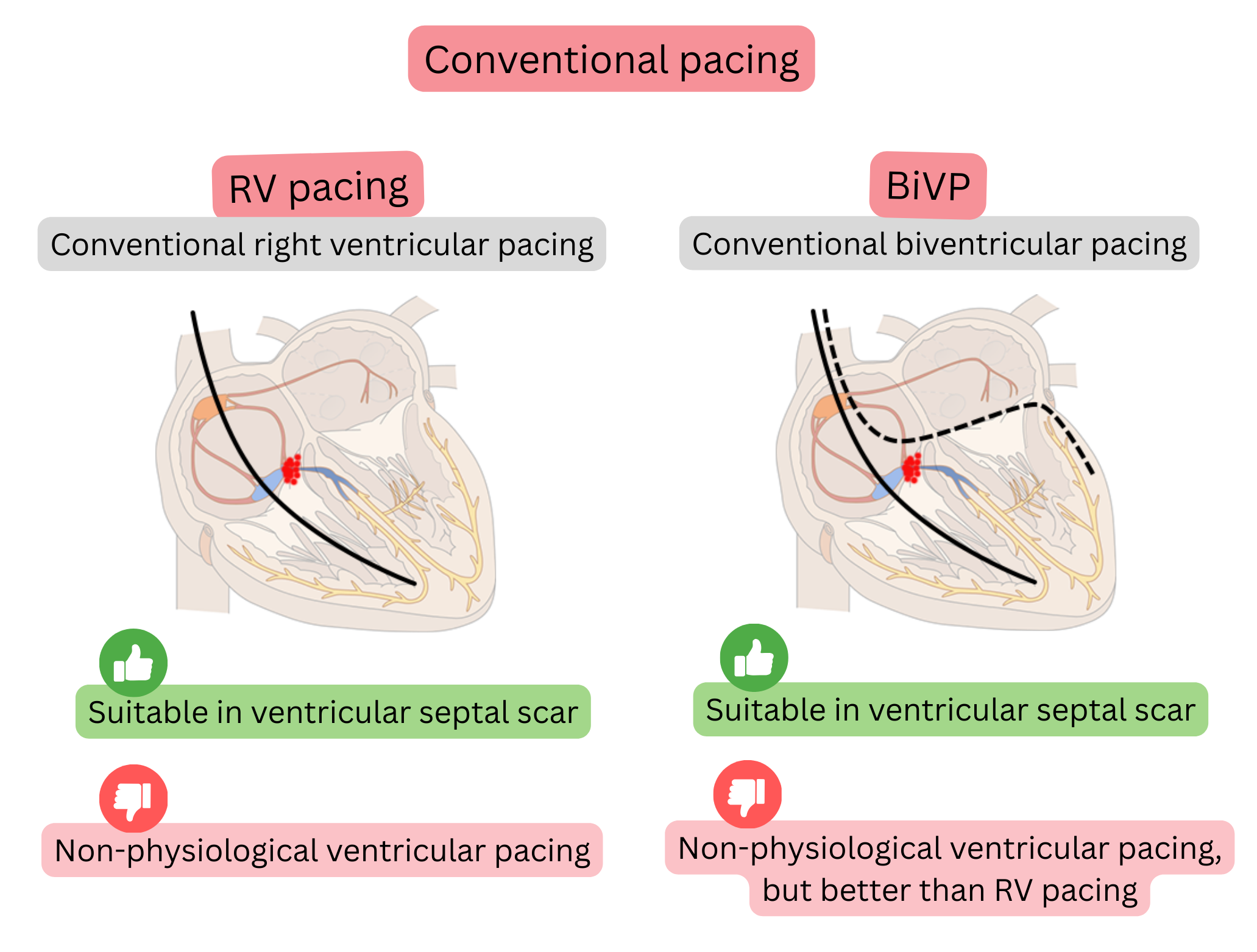 Diagram of conventional pacing comparing right ventricular pacing and biventricular pacing with their effects on ventricular activation synchrony and physiological conduction.