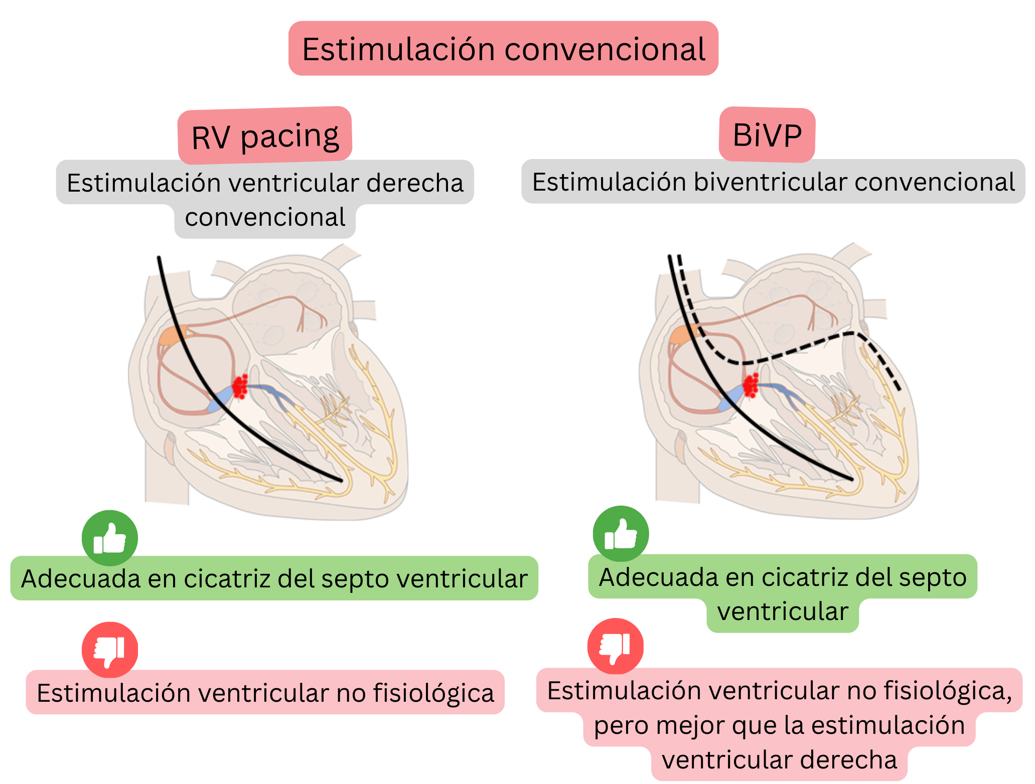 Esquema de estimulación convencional que compara la estimulación ventricular derecha y la estimulación biventricular en relación con la sincronía de activación ventricular y la fisiología de la conducción.