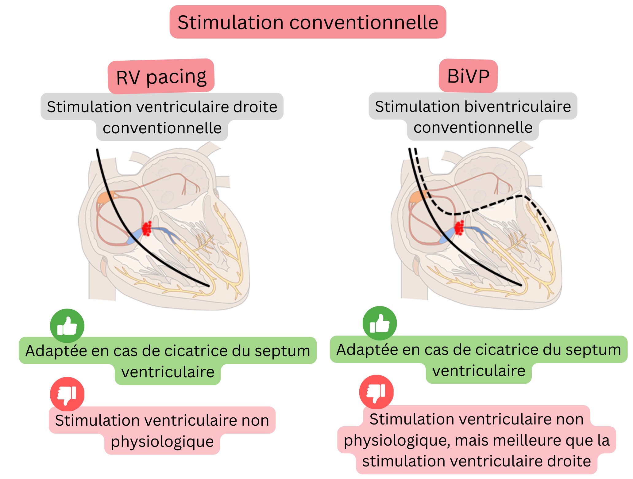 Schéma de stimulation conventionnelle comparant la stimulation ventriculaire droite et la stimulation biventriculaire quant à leurs effets sur la synchronisation de l’activation ventriculaire et la physiologie de la conduction.