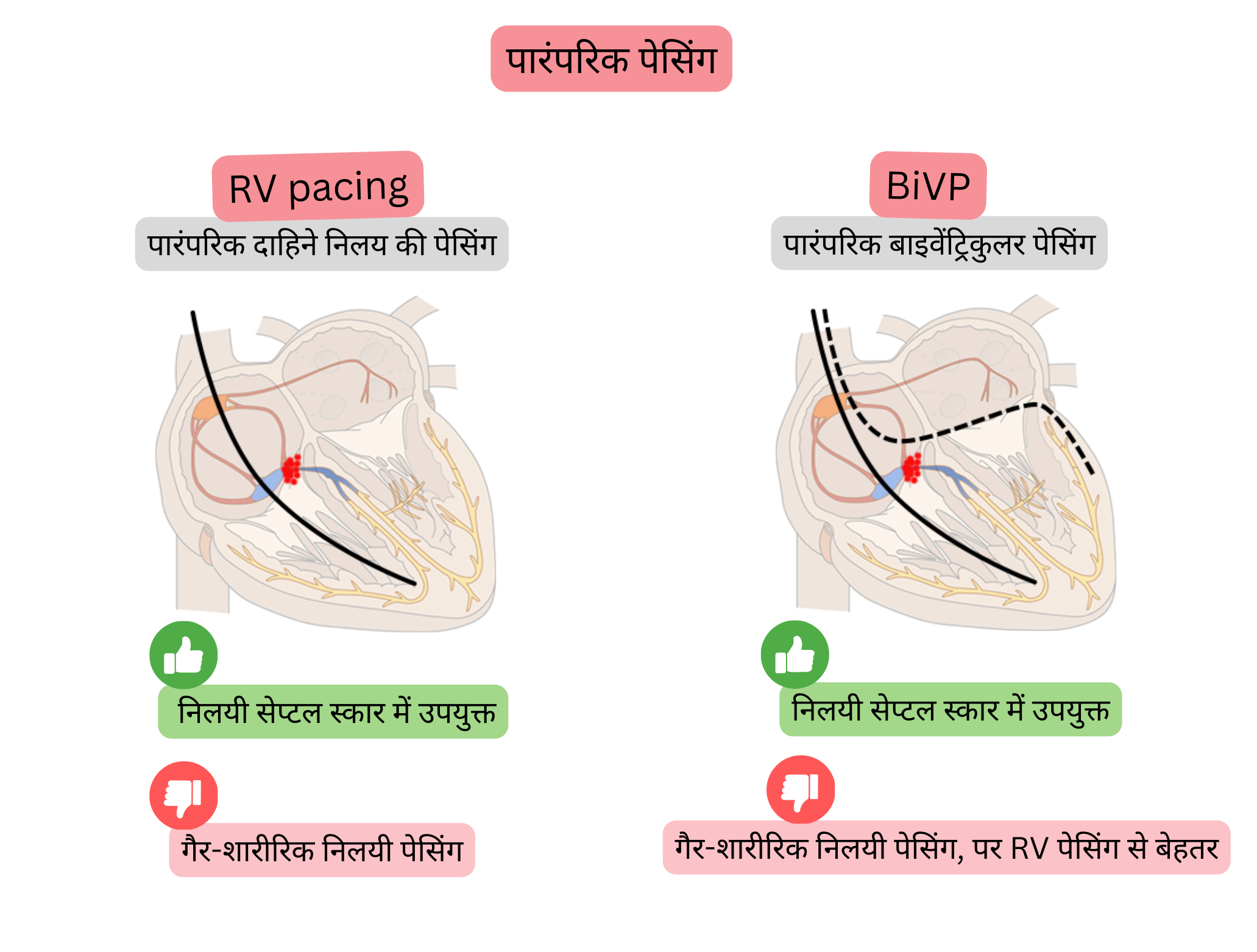 पारंपरिक पेसिंग का आरेख, जिसमें दाएँ निलय पेसिंग और द्विनिलयी पेसिंग की तुलना करते हुए निलयी सक्रियण की समकालिकता और विद्युत संचरण की शारीरिकता पर प्रभाव दर्शाया गया है।