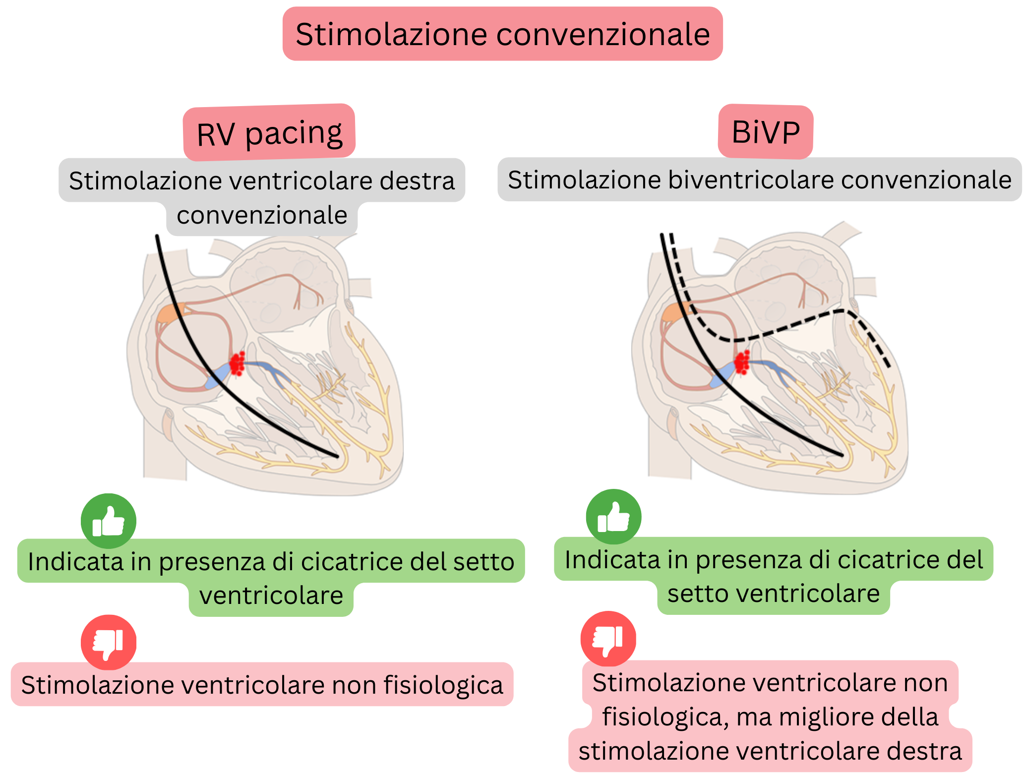 Schema di stimolazione convenzionale che confronta la stimolazione ventricolare destra e la stimolazione biventricolare in relazione alla sincronizzazione dell’attivazione ventricolare e alla fisiologia della conduzione.