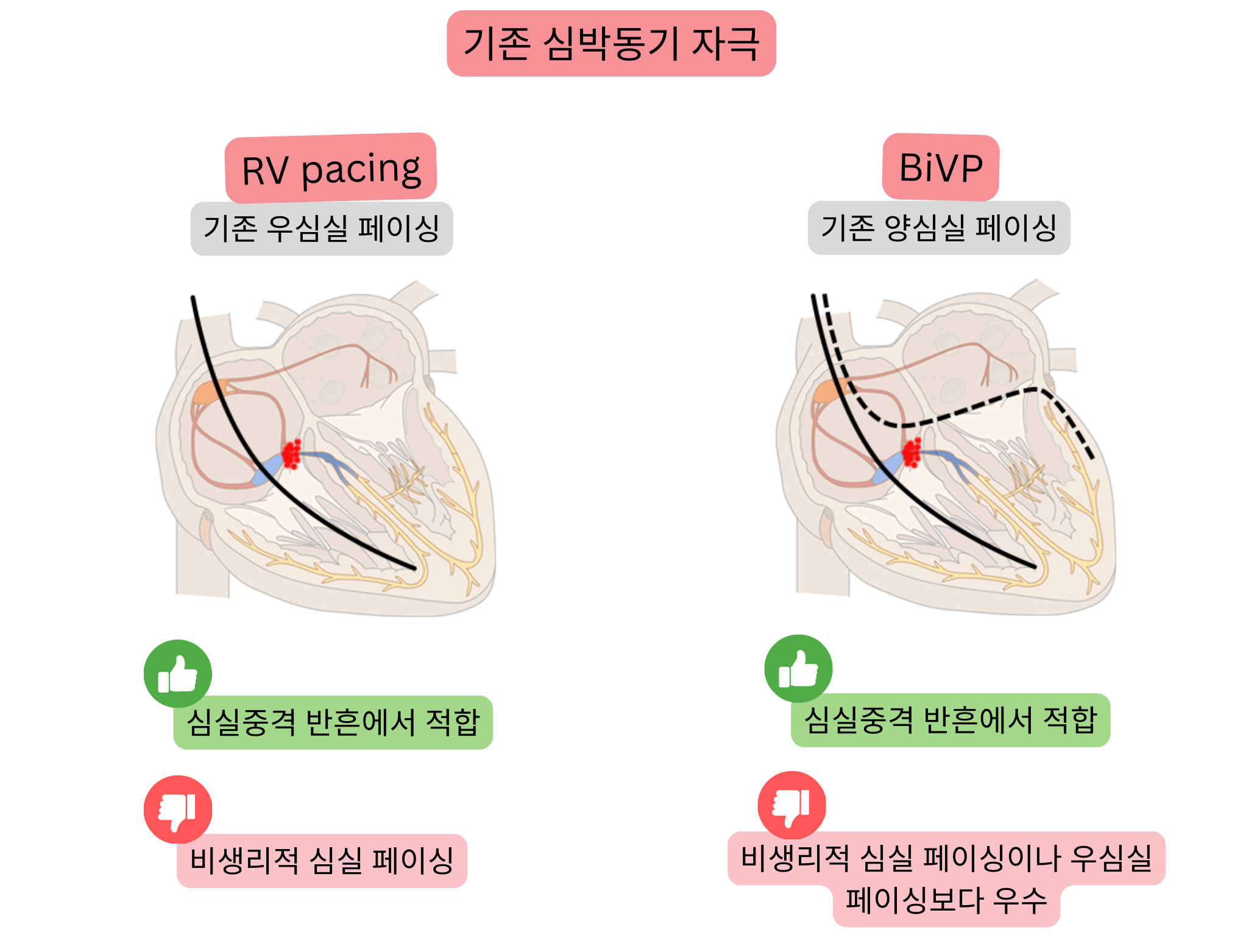 기존 심박동 조율 방식의 도식으로, 우심실 조율과 양심실 조율을 비교하여 심실 활성화의 동기화와 전도 생리성에 미치는 영향을 나타낸다.