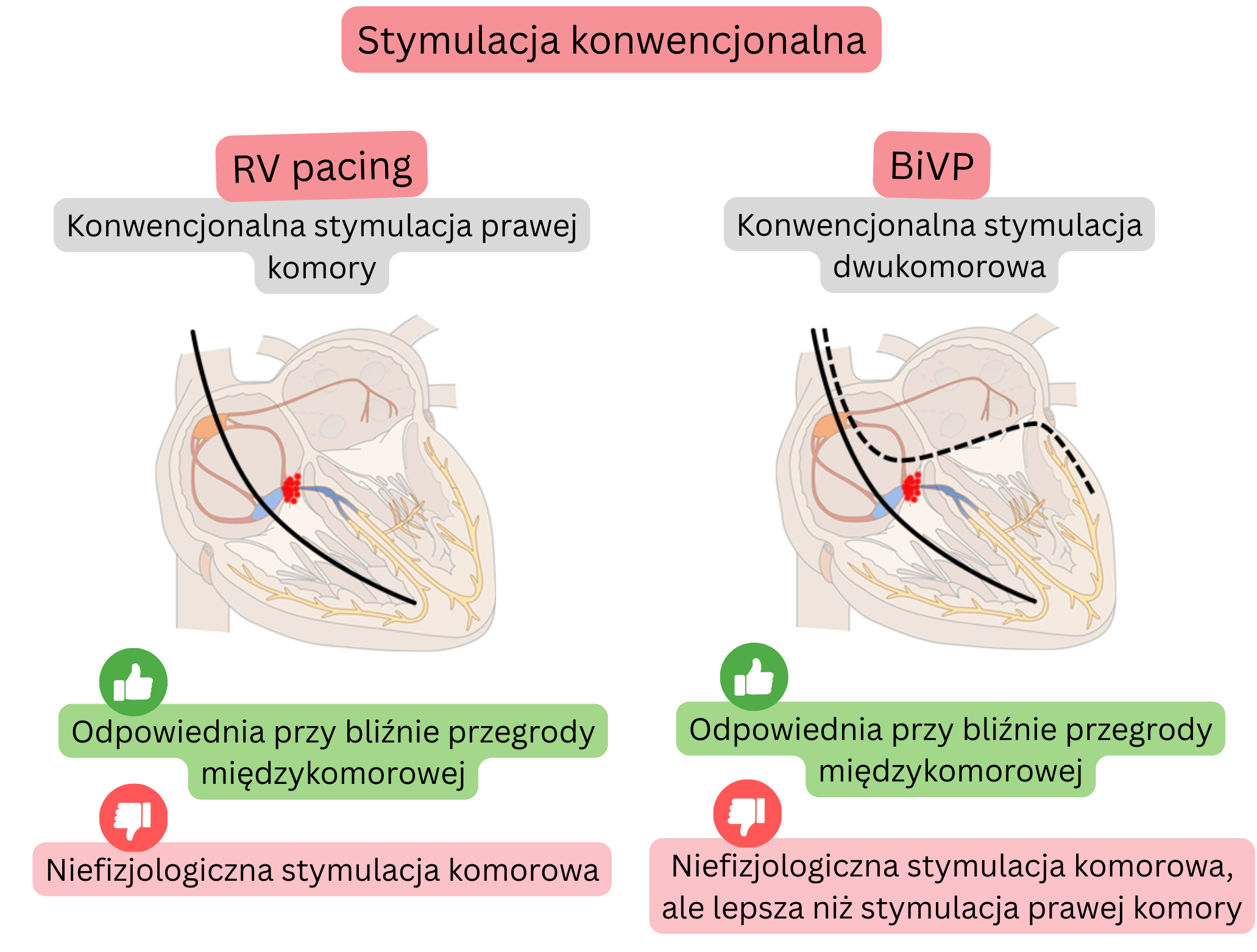 Schemat stymulacji konwencjonalnej porównujący stymulację prawej komory i stymulację biventrikularną pod względem wpływu na synchronizację aktywacji komór i fizjologiczność przewodzenia.