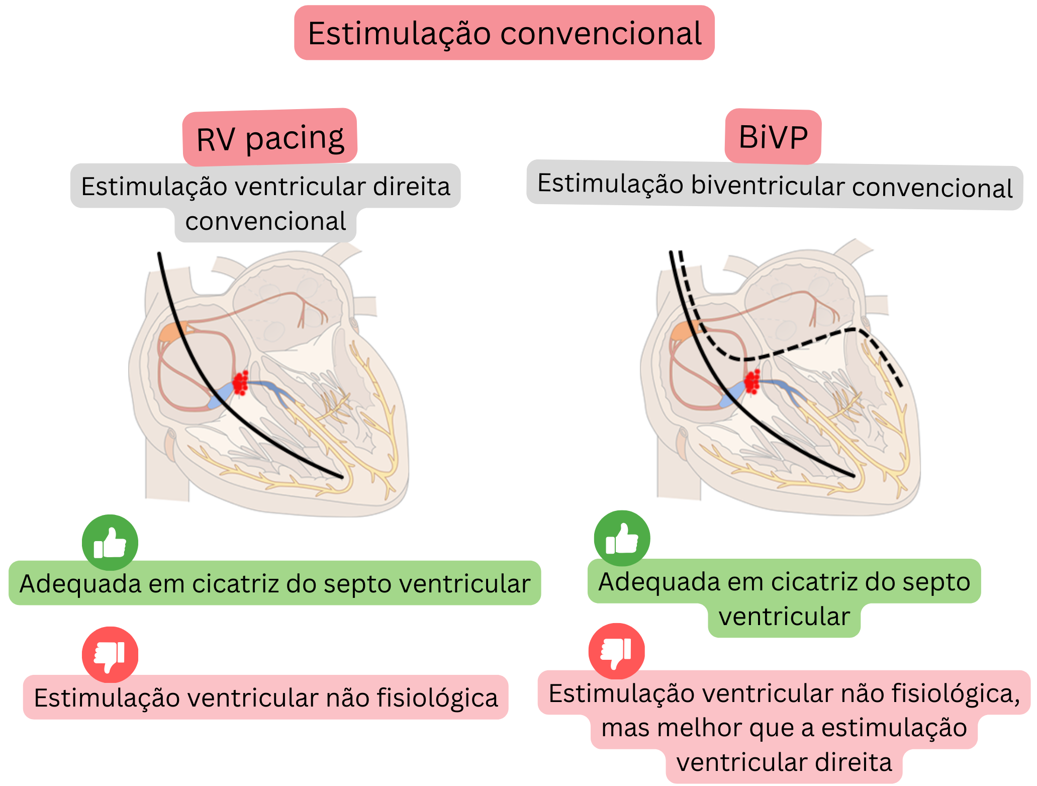 Esquema de estimulação convencional comparando a estimulação ventricular direita e a estimulação biventricular quanto ao impacto na sincronização da ativação ventricular e na condução fisiológica.