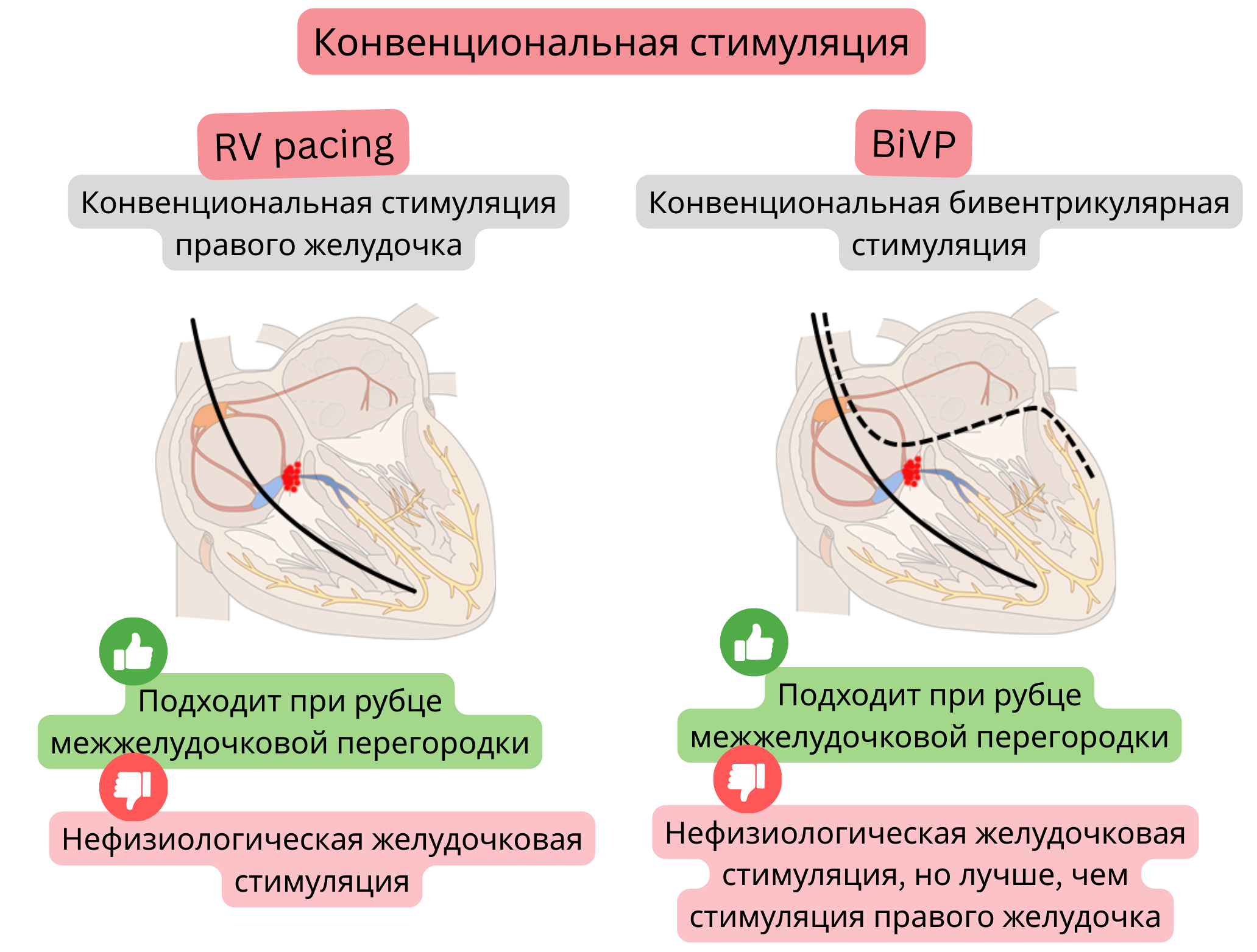 Схема традиционной стимуляции, сравнивающая правожелудочковую и бивентрикулярную стимуляцию с точки зрения влияния на синхронизацию активации желудочков и физиологичность проведения.