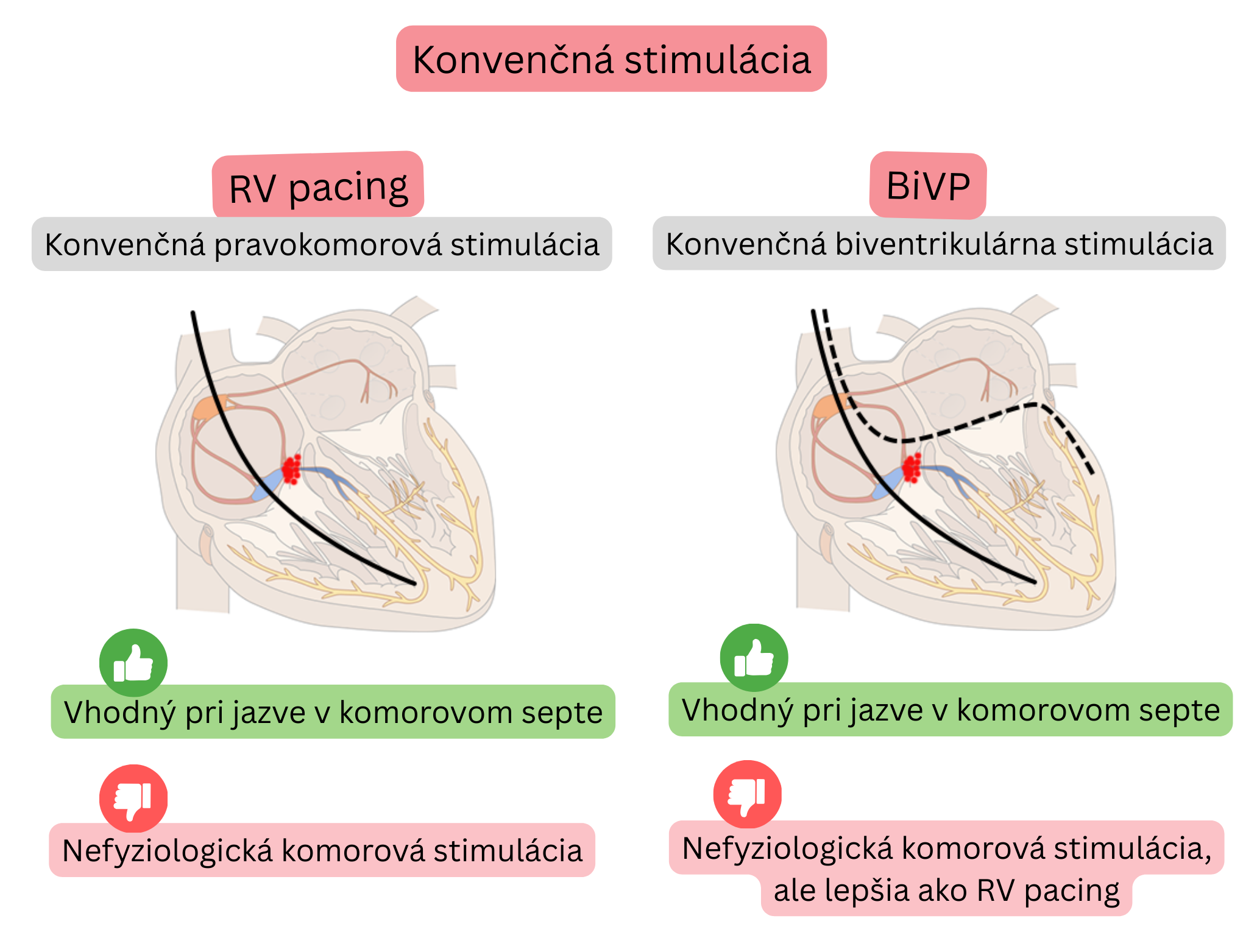 Schéma konvenčnej stimulácie porovnávajúca pravokomorovú a biventrikulárnu stimuláciu s ich vplyvom na synchronizáciu komorovej aktivácie a fyziologickosť elektrického vedenia.