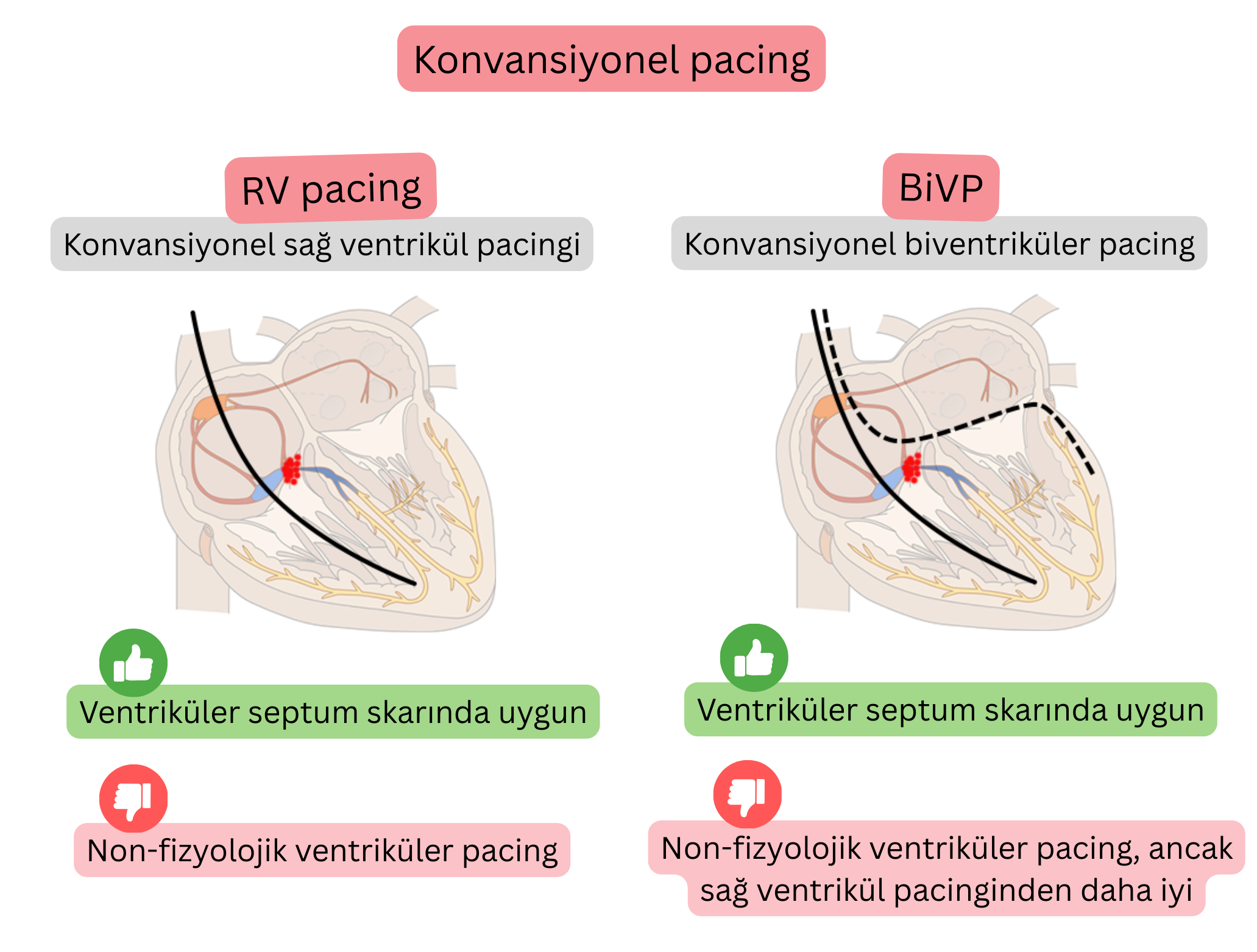 Konvansiyonel pacing şeması, sağ ventrikül pacingi ile biventriküler pacingi karşılaştırarak ventriküler aktivasyon senkronizasyonu ve iletimin fizyolojikliği üzerindeki etkilerini göstermektedir.