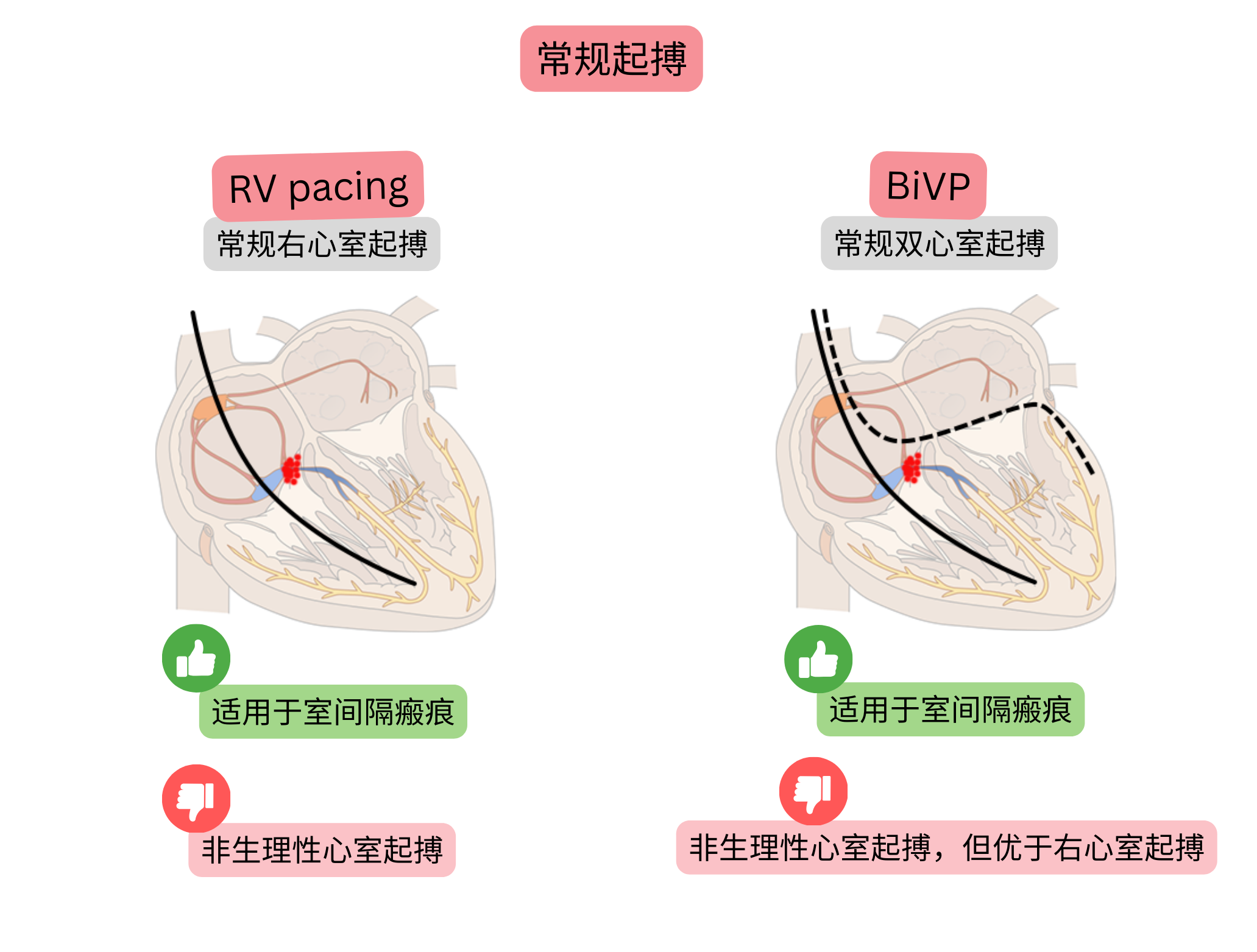 传统起搏方式示意图，对比右心室起搏与双心室起搏对心室激动同步性及电传导生理性的影响。