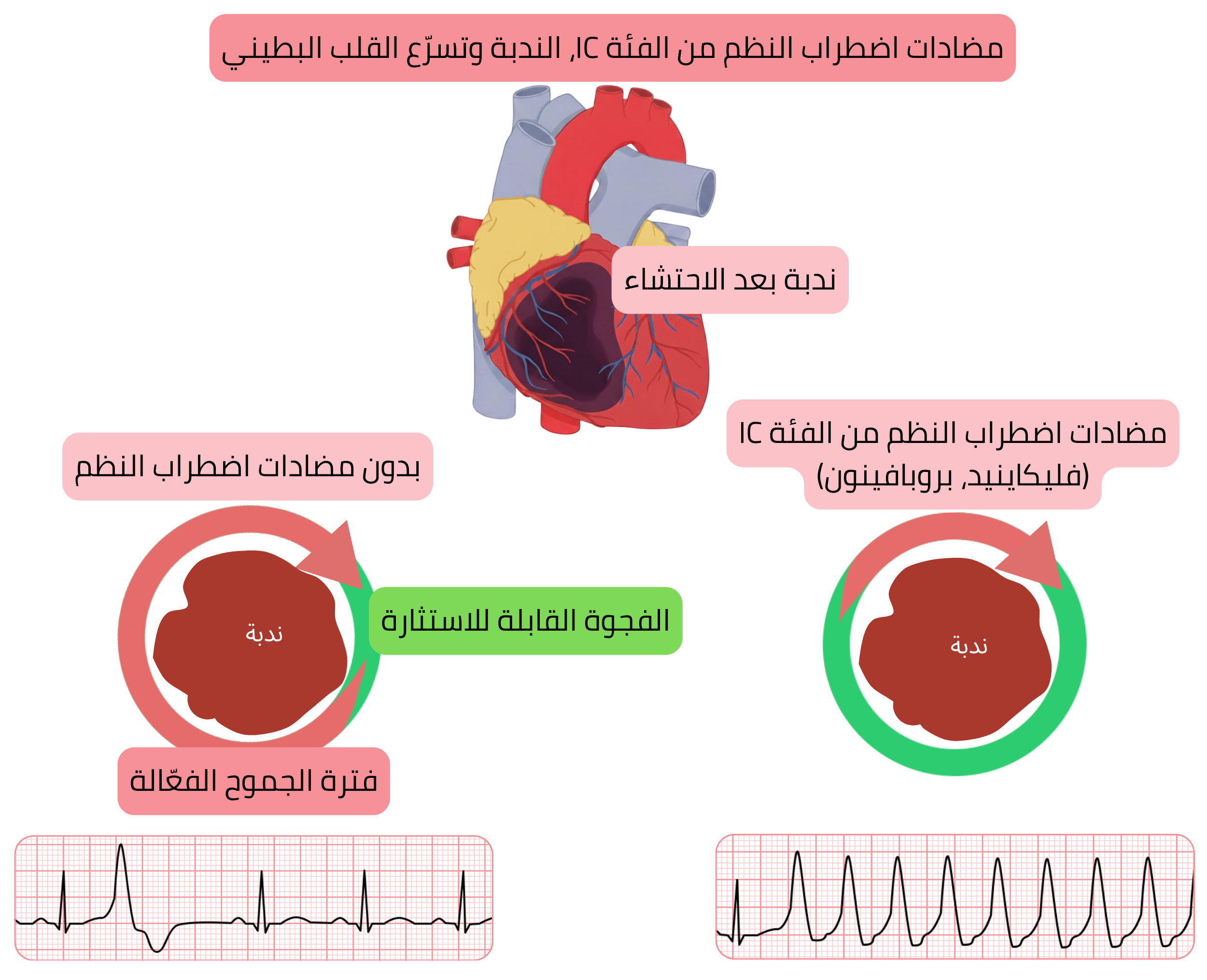 مخطط يوضح الآلية المُحَفِّزة لاضطراب النظم لمضادات اضطراب النظم من الفئة IC في ندبة ما بعد احتشاء عضلة القلب، مع تشكّل فجوة قابلة للاستثارة تؤدي إلى تسرّع بطيني.