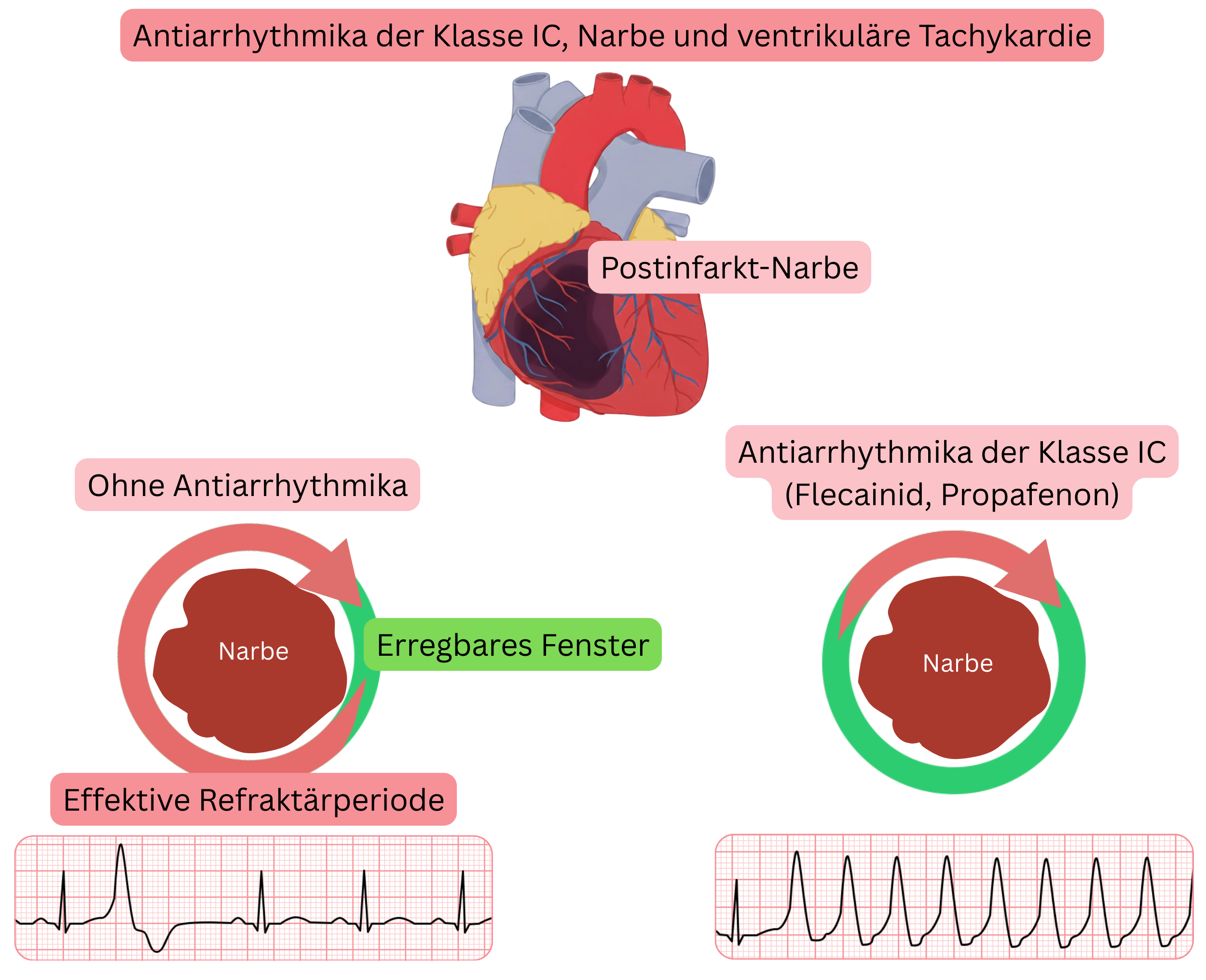 Schema zur Darstellung des proarrhythmischen Mechanismus von Antiarrhythmika der Klasse IC im Myokardinfarktnarbengewebe mit Bildung eines erregbaren Gaps, das zu ventrikulärer Tachykardie führt.