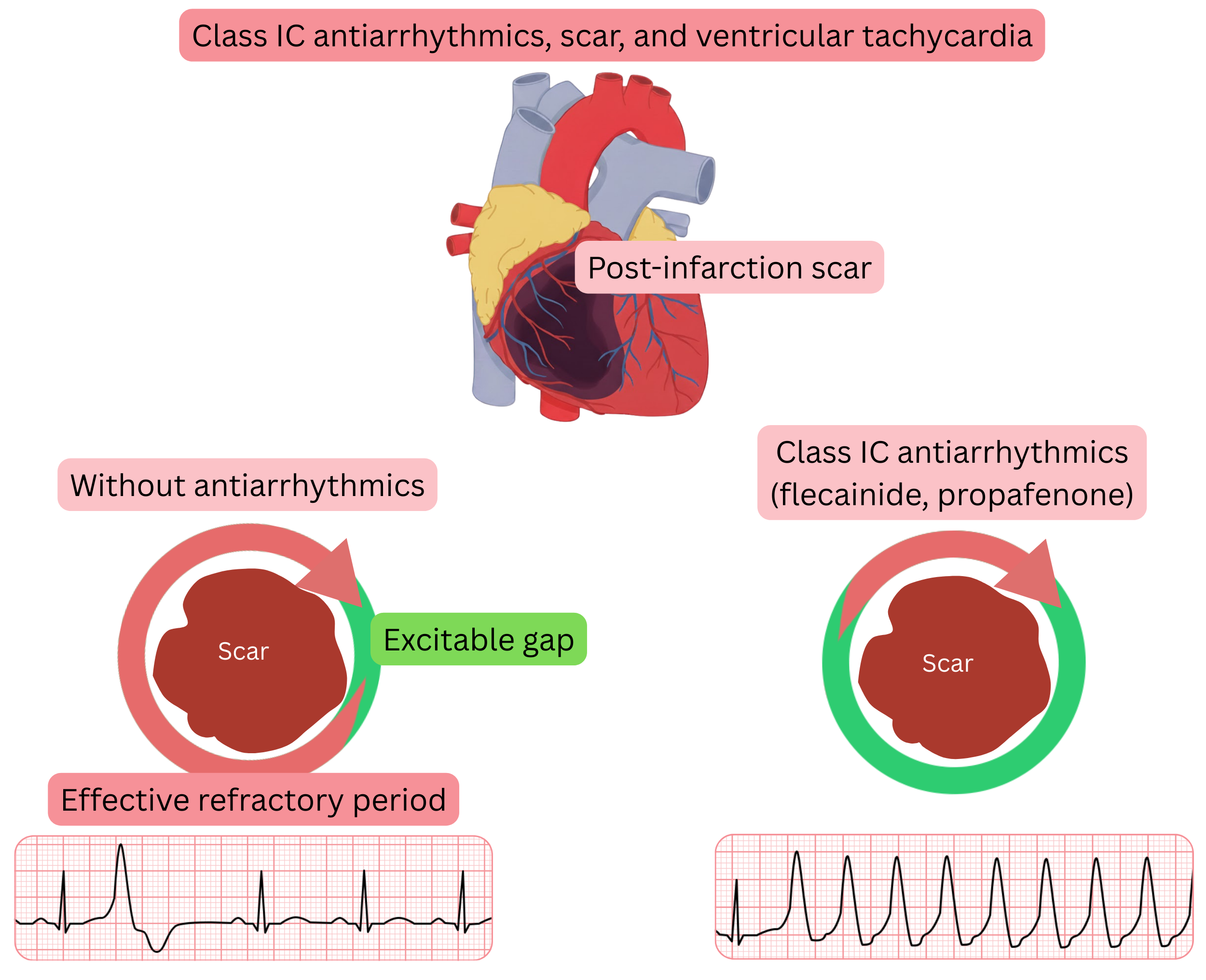 Diagram illustrating the proarrhythmic mechanism of class IC antiarrhythmic drugs in post–myocardial infarction scar tissue, with formation of an excitable gap leading to ventricular tachycardia.