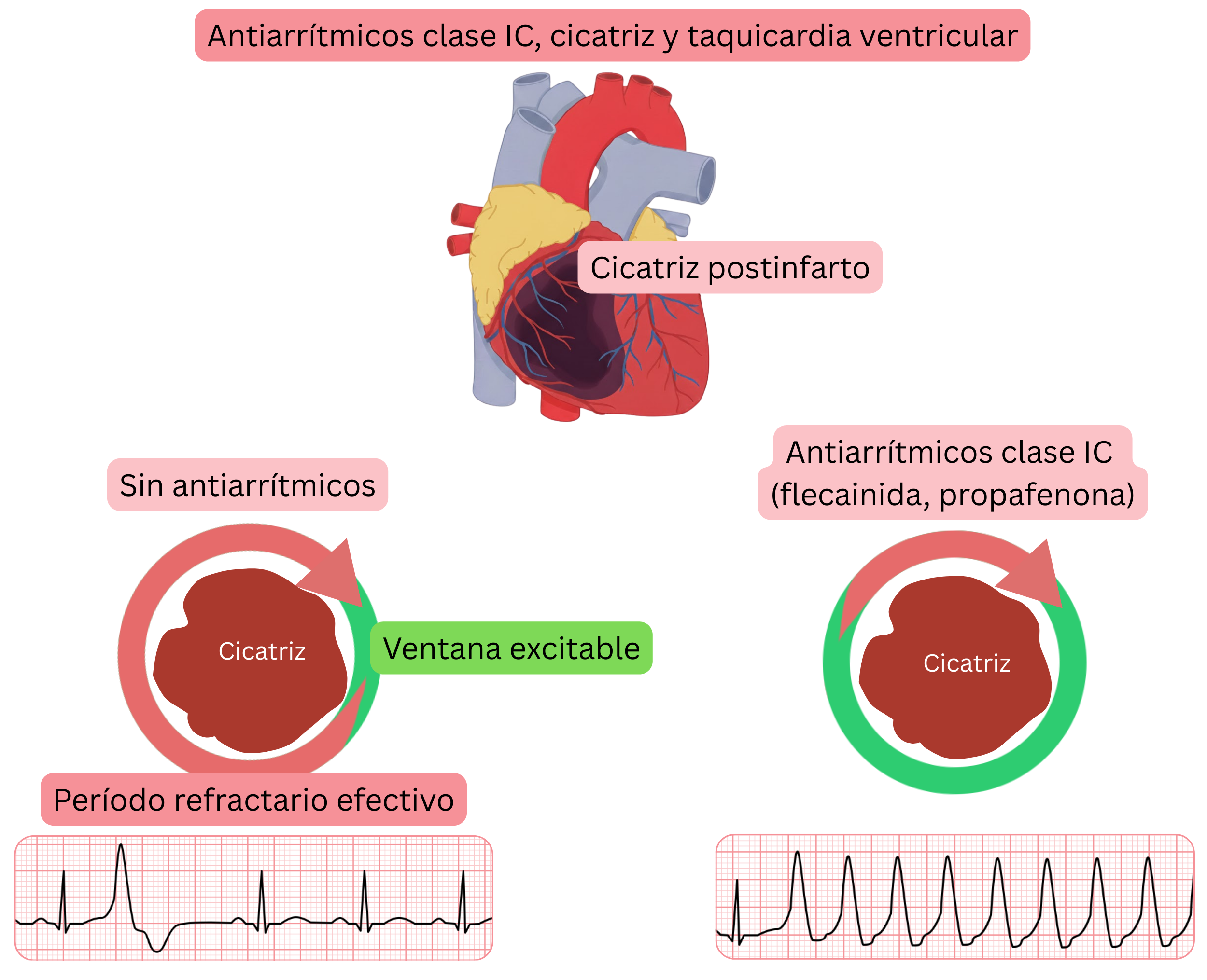 Esquema que ilustra el mecanismo proarrítmico de los antiarrítmicos de clase IC en la cicatriz postinfarto de miocardio, con formación de un gap excitable que conduce a taquicardia ventricular.