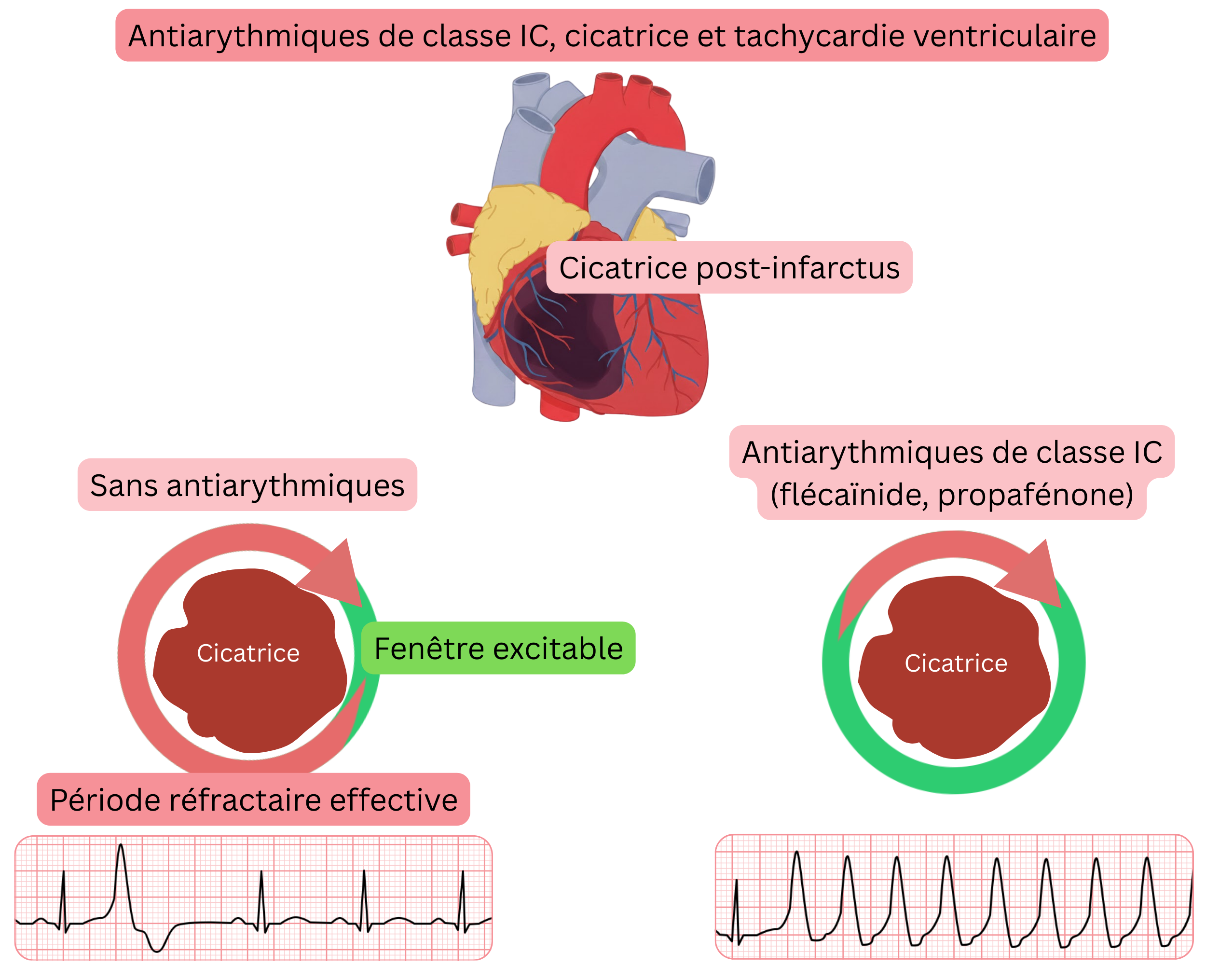 Schéma illustrant le mécanisme proarythmique des antiarythmiques de classe IC au niveau de la cicatrice post-infarctus du myocarde, avec création d’un gap excitable conduisant à une tachycardie ventriculaire.