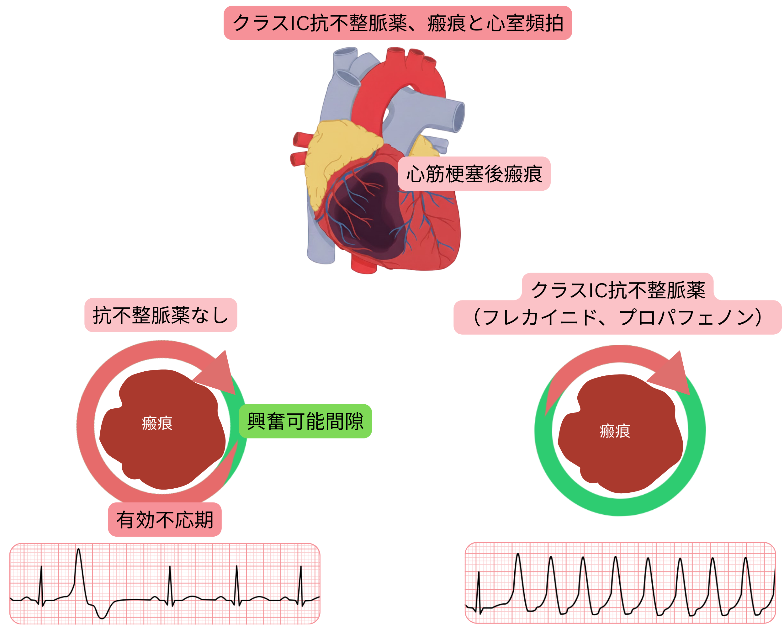 心筋梗塞後瘢痕におけるIC群抗不整脈薬の催不整脈機序を示す模式図で、興奮可能ギャップの形成により心室頻拍が生じることを示している。