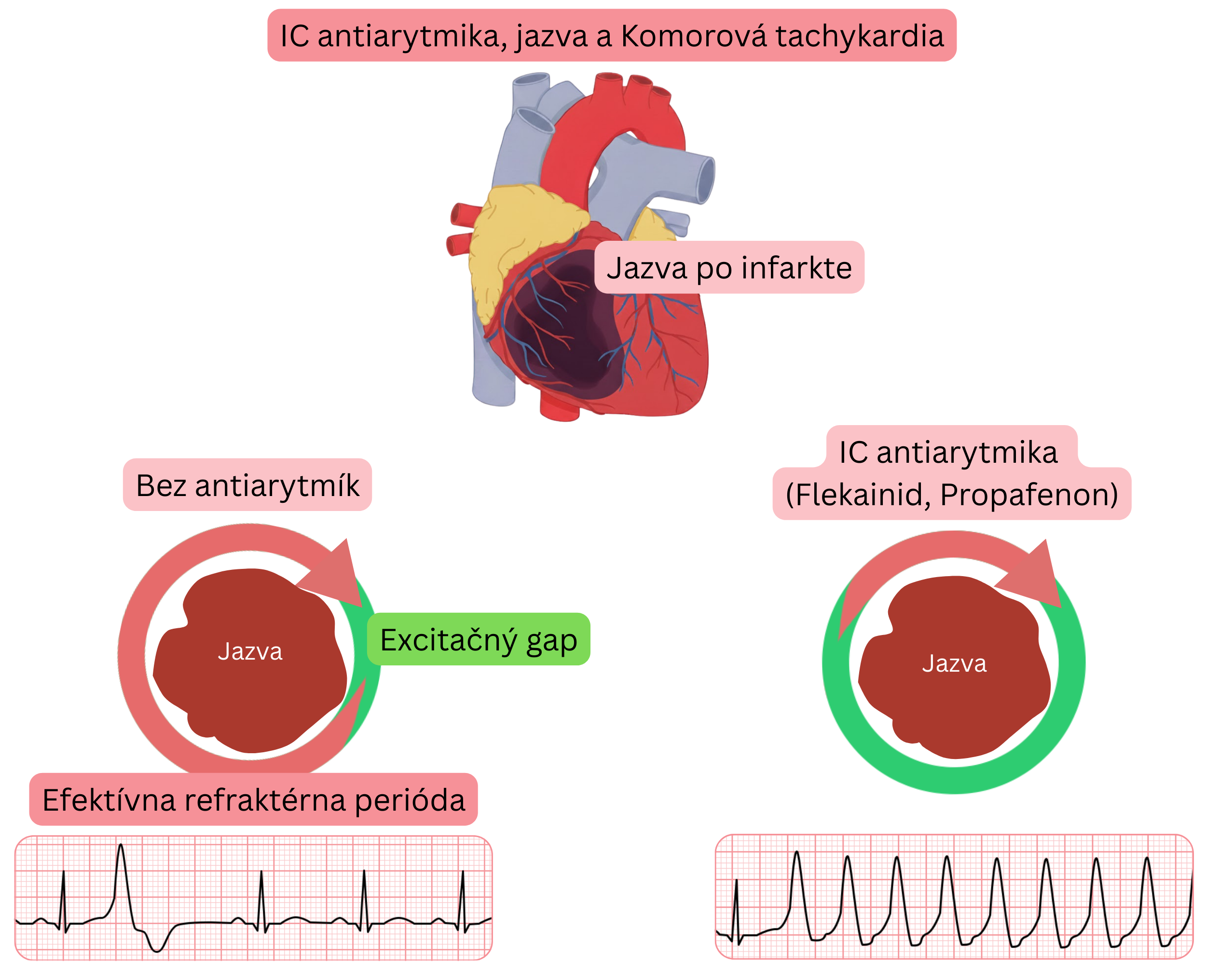 Schéma znázorňujúca proarytmický mechanizmus antiarytmík triedy IC pri jazve po infarkte myokardu s vytvorením excitačného gapu vedúceho ku komorovej tachykardii.
