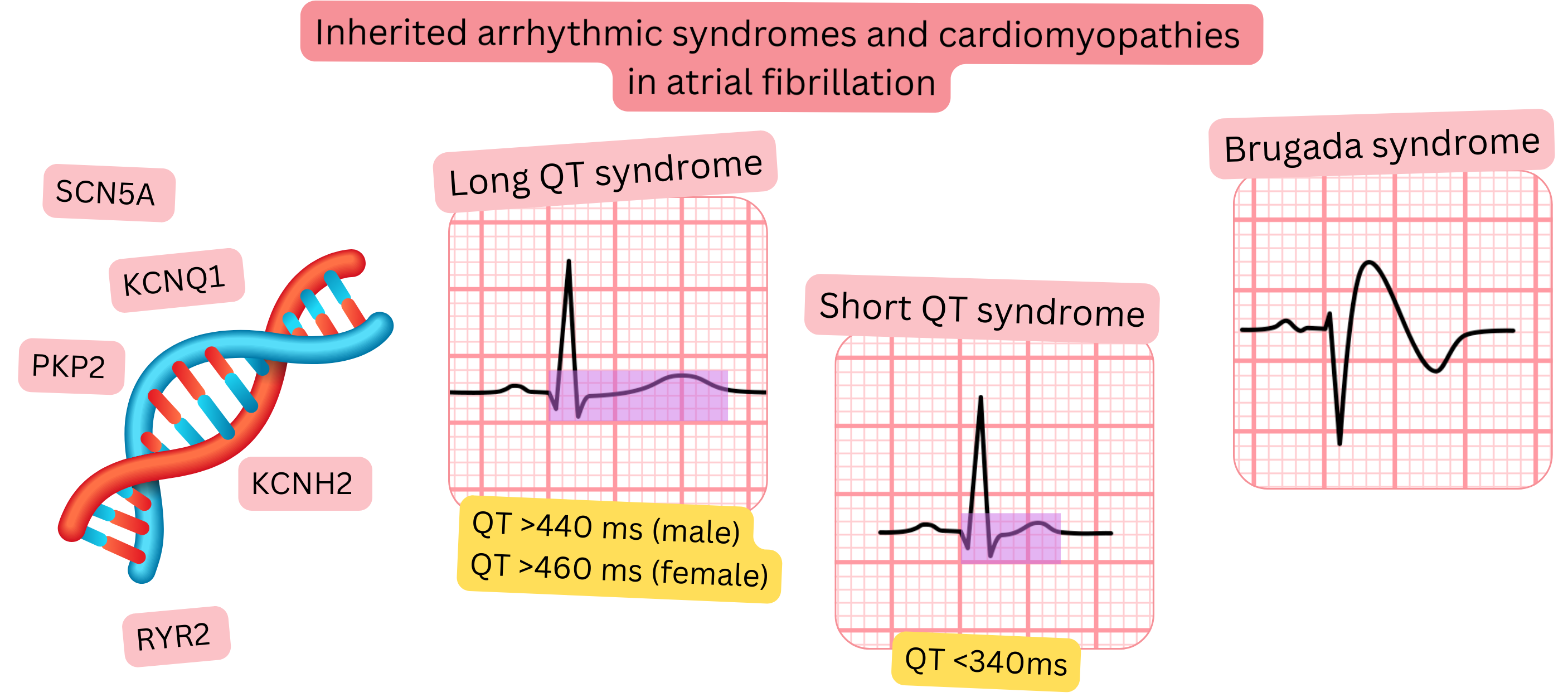 Overview of inherited arrhythmic syndromes and cardiomyopathies associated with atrial fibrillation, including long QT syndrome, short QT syndrome, and Brugada syndrome with characteristic ECG features and genetic mutations.