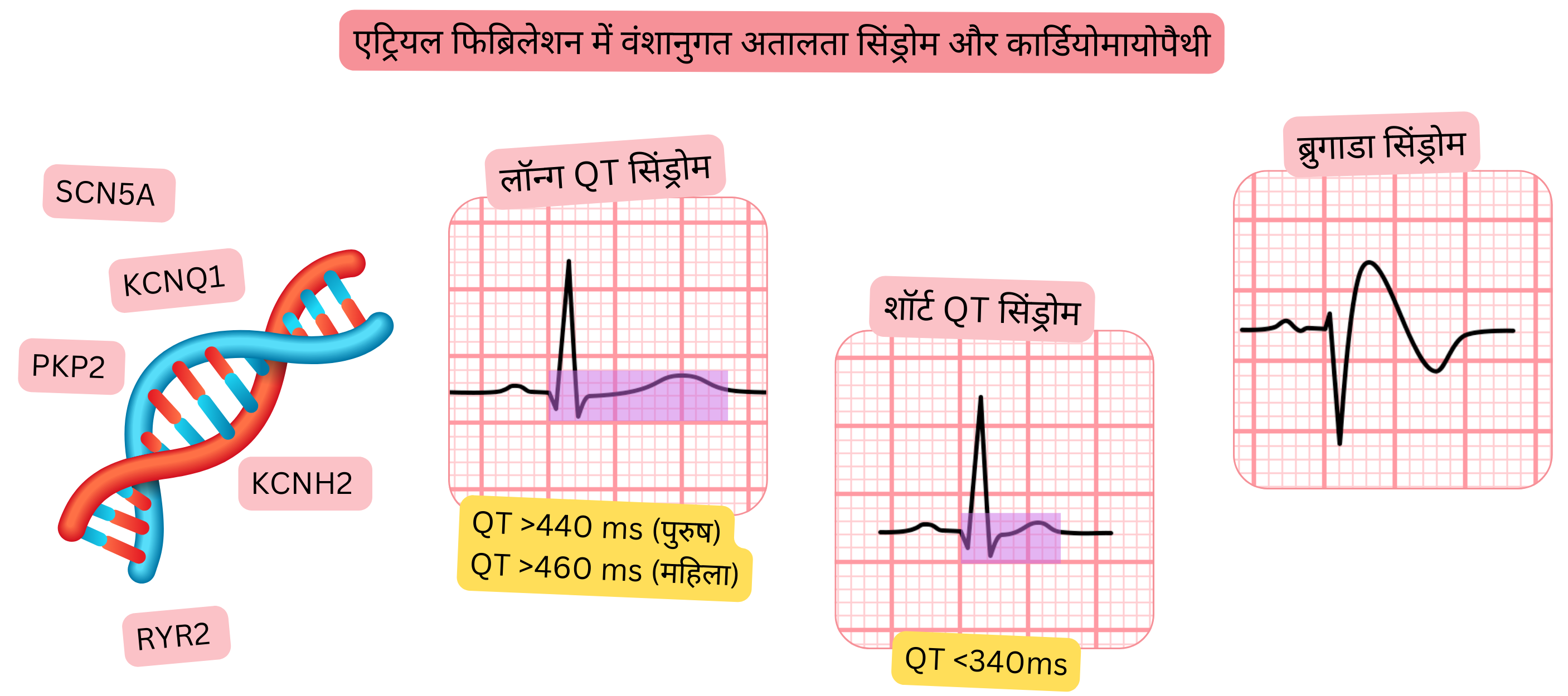वंशानुगत एरिदमिक सिंड्रोम और एट्रियल फ़िब्रिलेशन से संबद्ध कार्डियोमायोपैथियों का अवलोकन, जिसमें लॉन्ग QT सिंड्रोम, शॉर्ट QT सिंड्रोम और ब्रुगाडा सिंड्रोम उनके विशिष्ट ईसीजी लक्षणों और आनुवंशिक उत्परिवर्तनों सहित शामिल हैं।