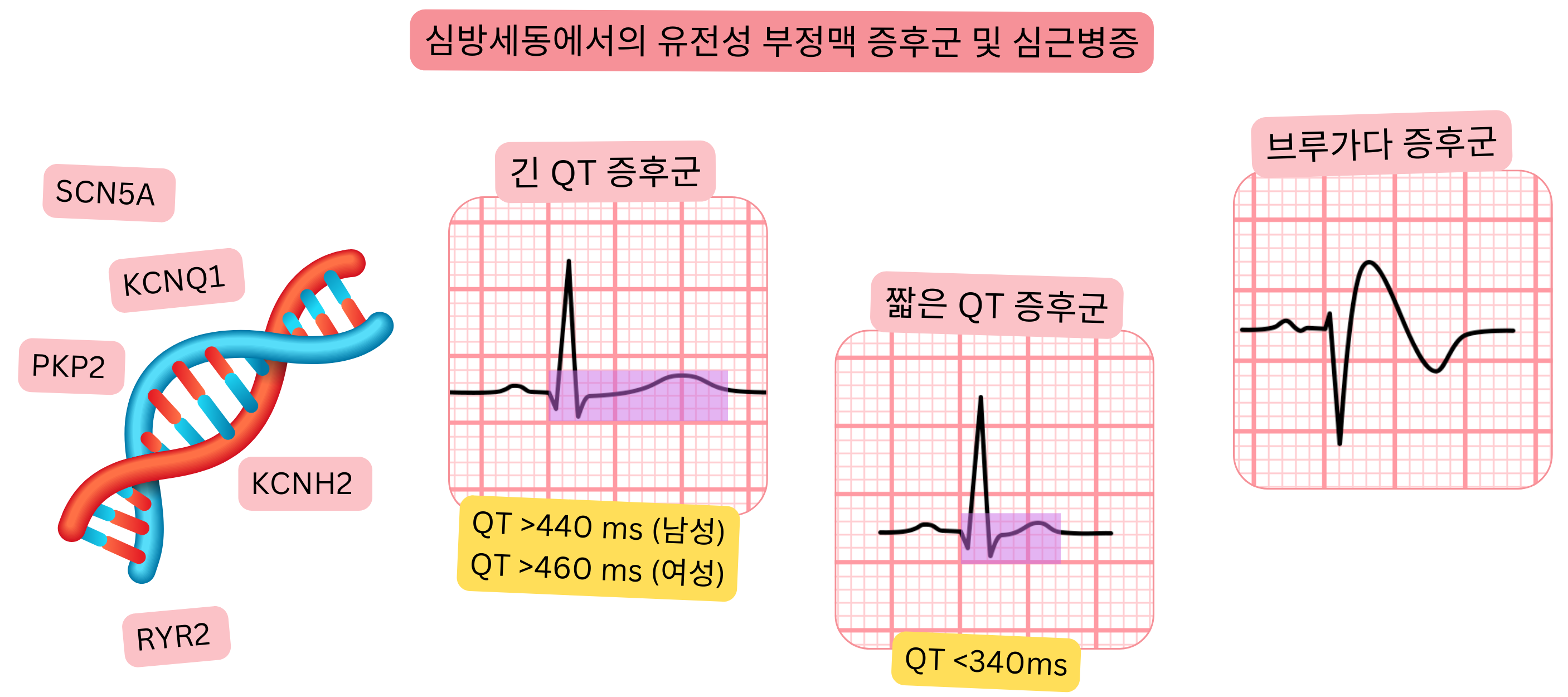 심방세동과 연관된 유전성 부정맥 증후군 및 심근병증의 개요로, 긴 QT 증후군, 짧은 QT 증후군, 브루가다 증후군을 포함하며 특징적인 심전도 소견과 유전자 변이를 제시한다.